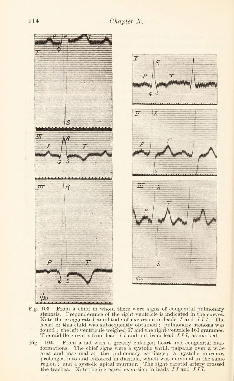 Fig. 103. From a child in whom there were signs of congenital pulmonary stenosis. Preponderance of the right ventricle is indicated in the curves. Note the exaggerated amplitude of excursion in leads I and III. The heart of this child was subsequently obtained ; pulmonary stenosis was found ; the left ventricule weighed 67 and the right ventricle 161 grammes. The middle curve is from lead 11 and not from lead III, as marked. Fig. 104. From a lad with a greatly enlarged heart and congenital mal¬ formations. The chief signs were a systolic thrill, palpable over a wide area and maximal at the pulmonary cartilage; a systolic murmur, prolonged into and enforced in diastole, which was maximal in the same region ; and a systolic apical murmur. The right carotid artery crossed the trachea. Note the increased excursion in leads 11 and II I.