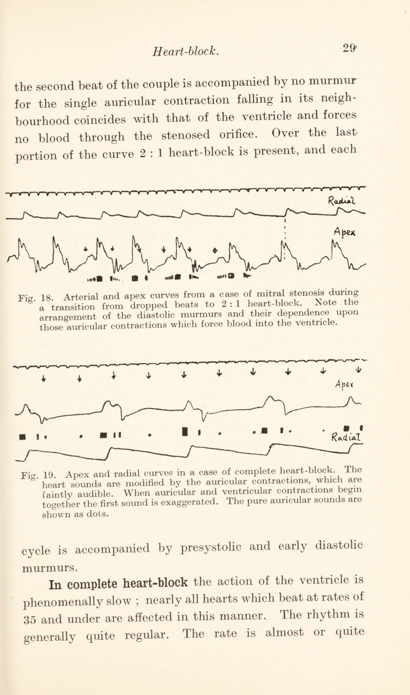 the second beat of the couple is accompanied by no murmur for the single auricular contraction falling in its neigh¬ bourhood coincides with that of the ventricle and forces no blood through the stenosed orifice. Over the last portion of the curve 2 : 1 heart-block is present, and each Fig. 18 Arterial and apex curves from a case of mitral stenosis during a transition from dropped beats to 2 : 1 heart-block. Note the arrangement of the diastolic murmurs and their dependence upon those auricular contractions which force blood into the ventricle. Trier 19. Apex and radial curves in a case of complete heart-block. The ^ heart sounds are modified by the auricular contractions, which are faintly audible. When auricular and ventricular contractions begin together the first sound is exaggerated. The pure auricular sounds are shown as dots. cycle is accompanied by presystolic and early diastolic murmurs. In complete heart-block the action of the ventricle is phenomenally slow ; nearly all hearts which beat at rates of 35 and under are affected in this manner. The rhythm is generally quite regular. The rate is almost or quite