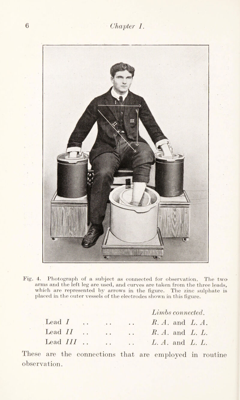 Fig. 4. Photograph of a subject as connected for observation. The two arms and the left leg are used, and curves are taken from the three leads, which are represented by arrows in the figure. The zinc sulphate is placed in the outer vessels of the electrodes shown in this figure. Lead / ,. Lead II Lead III .. Limbs connected. B. A. and L. A. B. A. and L. L. L. A. and L. L. These are the connections that are employed in routine observation.