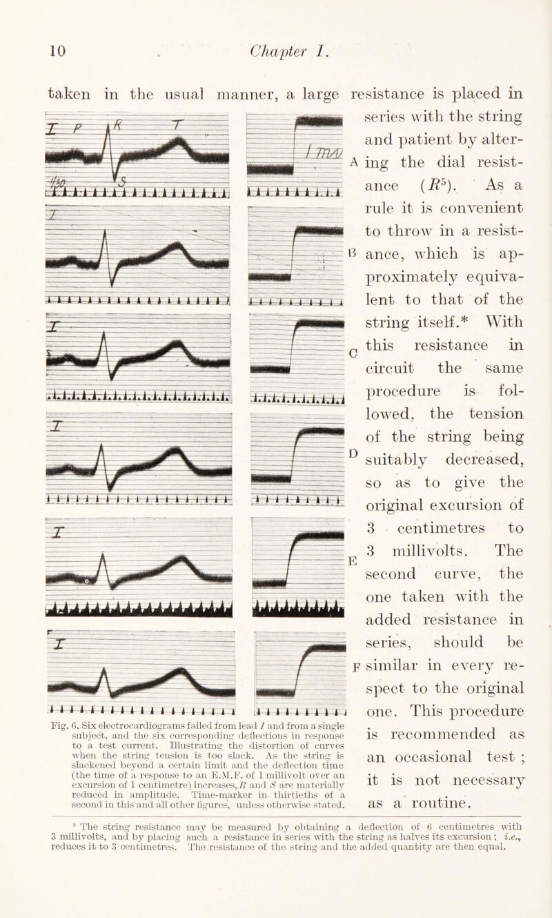 taken in the usual manner, a large resistance is placed in series with the string and patient by alter- A ing the dial resist- B ance, which is ap- string itself,* With this resistance in circuit the same procedure is fol¬ lowed, the tension of the string being D suitably decreased, so as to give the ~~i i i—i - J f 4-- J—4— ♦ • 1 • p --Da3z2i original excursion ot 3 centimetres to 3 millivolts. The second curve, the ttiddddddddddddddi one taken with the added resistance in series, should be F similar in every re- ance (i?5). As a rule it is convenient to throw in a resist- proximately equiva¬ lent to that of the *^*1.i,i.l.i.l.l.i. 1 a ' - <• ■ ■ — —3 spect to the original one. This procedure is recommended as an occasional test ; it is not necessary as a routine. bed: Pig. 6. Six electrocardiograms failed from lead I and from a single subject, and the six corresponding deflections in response to a test current. Illustrating^ the distortion of curves when the string tension is too slack. As the string is slackened beyond a certain limit and the deflection time (the time of a response to an E.M.F. of 1 millivolt oyer an excursion of 1 centimetre) increases, R and are materially reduced in amplitude. Time-marker in thirtieths of a second in this and all other figures, unless otherwise stated. * The string resistance may be measured by obtaining a deflection of 6 centimetres with 3 millivolts, and by placing such a resistance in series with the string as halves its excursion; i.e., reduces it to 3 centimetres. The resistance of the string and the added quantity are then equal.