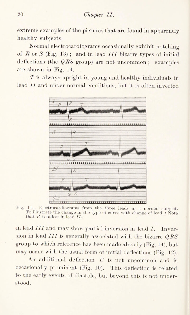 extreme examples of the pictures that are found in apparently healthy subjects. Normal electrocardiograms occasionally exhibit notching of R or S (Fig. 13) ; and in lead III bizarre types of initial deflections (the QRS group) are not uncommon ; examples are shown in Fig. 14. T is always upright in young and healthy individuals in lead II and under normal conditions, but it is often inverted Fig. 11. Electrocardiograms from the three leads in a normal subject. To illustrate the change in the type of curve with change of lead. * Note that jR is tallest in lead II. in lead III and may show partial inversion in lead I. Inver¬ sion in lead III is generally associated with the bizarre QRS group to which reference has been made already (Fig. 14), but may occur with the usual form of initial deflections (Fig. 12). An additional deflection U is not uncommon and is occasionally prominent (Fig. 10). This deflection is related to the early events of diastole, but beyond this is not under¬ stood.