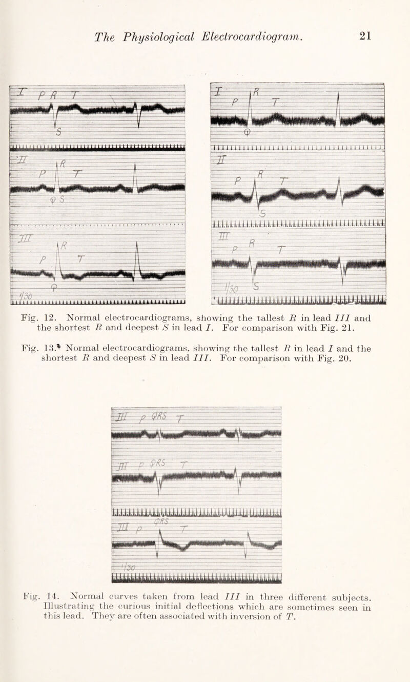 Fig. 12. Normal electrocardiograms, showing the tallest E in lead III and the shortest E and deepest S in lead I. For comparison with Fig. 21. Fig. 13.® Normal electrocardiograms, showing the tallest E in lead I and the shortest E and deepest S in lead III. For comparison with Fig. 20. Fig. 14. Normal curves taken from lead III in three different subjects. Illustrating the curious initial deflections which are sometimes seen in this lead. They are often associated with inversion of T.