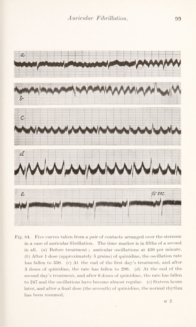 .Fig. 84. Five curves taken from a pair of contacts arranged over the sternum in a case of auricular fibrillation. The time marker is in fifths of a second in all. (a) Before treatment ; auricular oscillations at 450 per minute. (6) After 1 dose (approximately 5 grains) of quinidine, the oscillation rate has fallen to 350. (c) At the end of the first day’s treatment, and after 3 doses of quinidine, the rate has fallen to 296. (d) At the end of the second day’s treatment, and after 6 doses of quinidine, the rate has fallen to 247 and the oscillations have become almost regular. (e) Sixteen hours later, and after a final dose (the seventh) of quinidine, the normal rhythm has been resumed. h 2