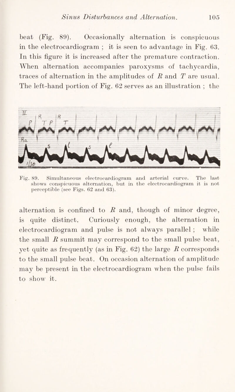 beat (Fig. 89). Occasionally alternation is conspicuous in the electrocardiogram ; it is seen to advantage in Fig. 63. In this figure it is increased after the premature contraction. When alternation accompanies paroxysms of tachycardia, traces of alternation in the amplitudes of R and T are usual. The left-hand portion of Fig. 62 serves as an illustration ; the Fig. 89. Simultaneous electrocardiogram and arterial curve. The last shows conspicuous alternation, but in the electrocardiogram it is not perceptible (see Figs. 62 and 63). alternation is confined to R and, though of minor degree, is quite distinct. Curiously enough, the alternation in electrocardiogram and pulse is not always parallel ; while the small R summit may correspond to the small pulse beat, yet quite as frequently (as in Fig. 62) the large R corresponds to the small pulse beat. On occasion alternation of amplitude may be present in the electrocardiogram when the pulse fails to show it.