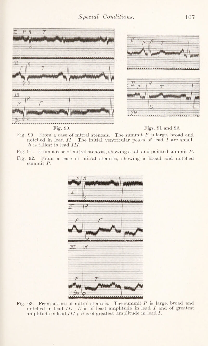 Fig. 90. Figs. 91 and 92. Fig. 90. From a case of mitral stenosis. The summit P is large, broad and notched in lead II. The initial ventricular peaks of lead I are small. R is tallest in lead III. Fig. 91. From a case of mitral stenosis, showing a tall and pointed summit P. Fig. 92. From a case of mitral stenosis, showing a broad and notched summit P. Fig. 93. From a case of mitral stenosis. The summit P is large, broad and notched in lead II. P is of least amplitude in lead 1 and of greatest amplitude in lead III; S is of greatest amplitude in lead I.