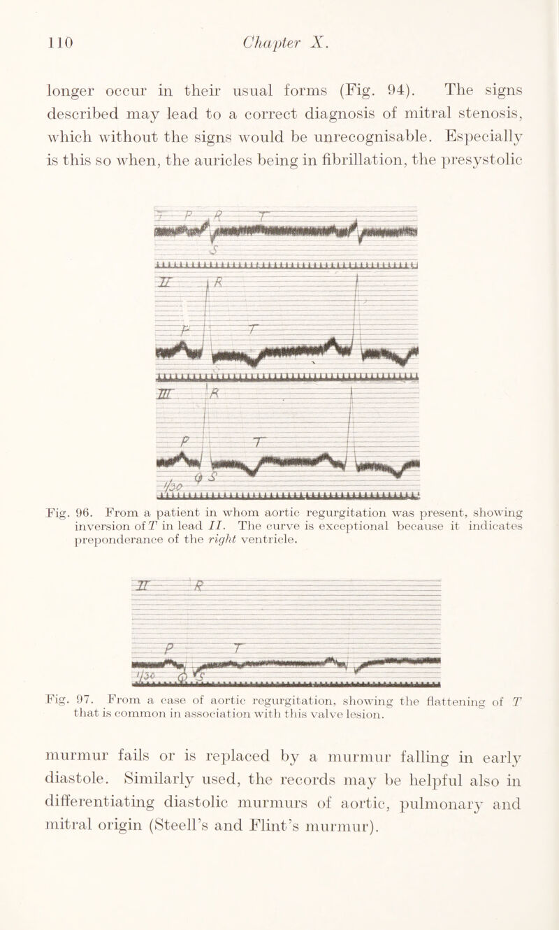 longer occur in their usual forms (Fig. 94). The signs described may lead to a correct diagnosis of mitral stenosis, which without the signs would be unrecognisable. Especially is this so when, the auricles being in fibrillation, the presystolic Pig. 96. From a patient in whom aortic regurgitation was present, showing inversion ofT in lead II. The curve is exceptional because it indicates preponderance of the right ventricle. ■p----—.~~-~r7r::-- Fig. 97. From a case of aortic regurgitation, showing the flattening of that is common in association with this valve lesion. T murmur fails or is replaced by a murmur falling in early diastole. Similarly used, the records may be helpful also in differentiating diastolic murmurs of aortic, pulmonary and mitral origin (Steells and Flint’s murmur).