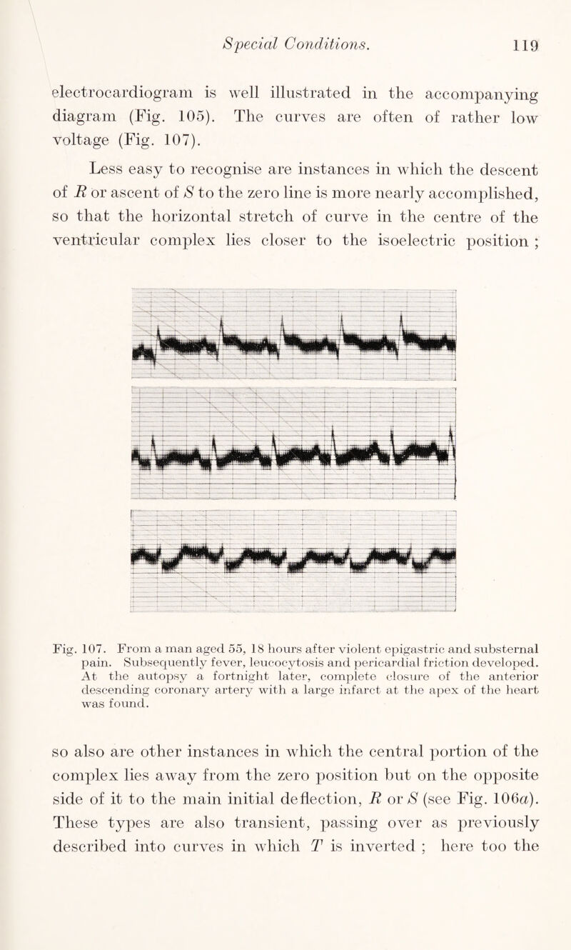 electrocardiogram is well illustrated in the accompanying diagram (Fig. 105). The curves are often of rather low voltage (Fig. 107). Less easy to recognise are instances in which the descent of E or ascent of S to the zero line is more nearly accomplished, so that the horizontal stretch of curve in the centre of the ventricular complex lies closer to the isoelectric position ; Fig. 107. From a man aged 55, 18 hours after violent epigastric and substernal pain. Subsequently fever, leucocytosis and pericardial friction developed. At the autopsy a fortnight later, complete closure of the anterior descending coronary artery with a large infarct at the apex of the heart was found. so also are other instances in which the central portion of the complex lies away from the zero position but on the opposite side of it to the main initial deflection, E or S (see Fig. 106a). These types are also transient, passing over as previously described into curves in which T is inverted : here too the