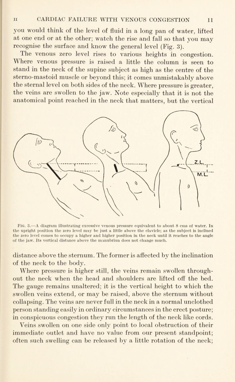 you would think of the level of fluid in a long pan of water, lifted at one end or at the other; watch the rise and fall so that you may recognise the surface and know the general level (Fig. 3). The venous zero level rises to various heights in congestion. Where venous pressure is raised a little the column is seen to stand in the neck of the supine subject as high as the centre of the sterno-mastoid muscle or beyond this; it comes unmistakably above the sternal level on both sides of the neck. Where pressure is greater, the veins are swollen to the jaw. Note especially that it is not the anatomical point reached in the neck that matters, but the vertical Fig. 3.—A diagram illustrating excessive venous pressure equivalent to about 8 cms of water. In the upright position the zero level may he just a little above the clavicle; as the subject is inclined the zero level comes to occupy a higher and higher position in the neck until it reaches to the angle of the jaw. Its vertical distance above the manubriun does not change much. distance above the sternum. The former is affected by the inclination of the neck to the body. Where pressure is higher still, the veins remain swollen through¬ out the neck when the head and shoulders are lifted off the bed. The gauge remains unaltered; it is the vertical height to which the swollen veins extend, or may be raised, above the sternum without collapsing. The veins are never full in the neck in a normal unclothed person standing easily in ordinary circumstances in the erect posture; in conspicuous congestion they run the length of the neck like cords. Veins swollen on one side only point to local obstruction of their immediate outlet and have no value from our present standpoint; often such swelling can be released by a little rotation of the neck;