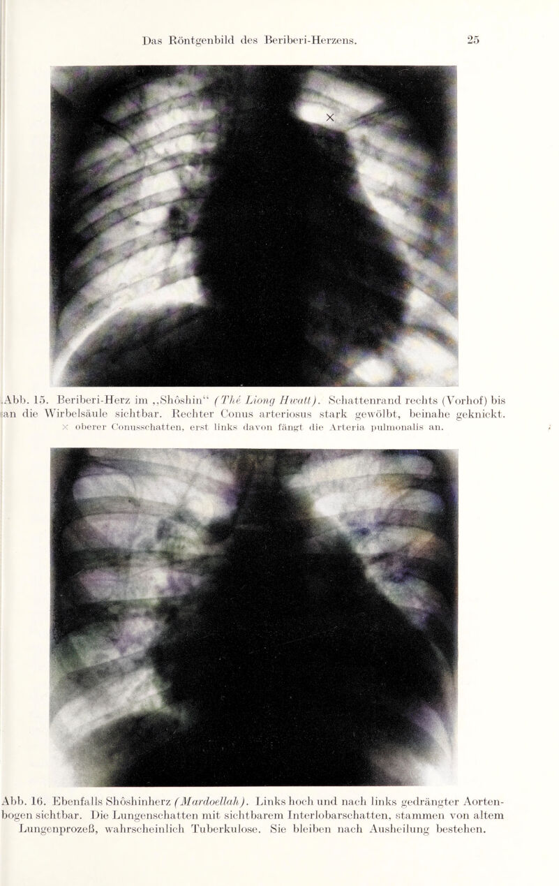.Abb. 15. Beriberi-Herz im „Shöshin“ (The Liong Hwatt). Schattenrand rechts (Vorhof) bis an die Wirbelsäule sichtbar. Rechter Conus arteriosus stark gewölbt, beinahe geknickt, x oberer Conusschatten, erst links davon fängt die Arteria prümonalis an. Abb. 16. Ebenfalls Shöshinherz (Mardoellah). Links hoch und nach links gedrängter Aorten¬ bogen sichtbar. Die Lungenschatten mit sichtbarem Interlobarschatten, stammen von altem Lungenprozeß, wahrscheinlich Tuberkulose. Sie bleiben nach Ausheilung bestehen.