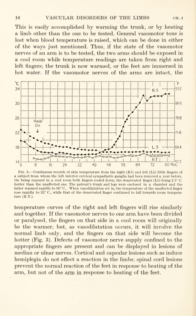 This is easily accomplished by warming the trunk, or by heating a limb other than the one to be tested. General vasomotor tone is lost when blood temperature is raised, which can be done in either of the ways just mentioned. Thus, if the state of the vasomotor nerves of an arm is to be tested, the two arms should be exposed in a cool room while temperature readings are taken from right and left fingers; the trunk is now warmed, or the feet are immersed in hot water. If the vasomotor nerves of the arms are intact, the Fig. 3.-—Continuous records of skin temperature from the right (R.5) and left (L5) little fingers of a subject from whom the left inferior cervical sympathetic ganglia had been removed a year before. On being exposed in a cool room both fingers cooled down, the denervated finger (L5) being 2-5° C. hotter than the unaffected one. The patient’s trunk and legs were enclosed in a chamber arid the latter warmed rapidly to 60° C.. When vasodilatation set in, the temperature of the unaffected finger rose rapidly to 32° C., while that of the denervated finger continued to fall towards room tempera¬ ture (B.T.). temperature curves of the right and left fingers will rise similarly and together. If the vasomotor nerves to one arm have been divided or paralysed, the fingers on that side in a cool room will originally be the warmer; but, as vasodilatation occurs, it will involve the normal limb only, and the fingers on that side will become the hotter (Fig. 3). Defects of vasomotor nerve supply confined to the appropriate fingers are present and can be displayed in lesions of median or ulnar nerves. Cortical and capsular lesions such as induce hemiplegia do not effect a reaction in the limbs; spinal cord lesions prevent the normal reaction of the feet in response to heating of the arm, but not of the arm in response to heating of the feet.
