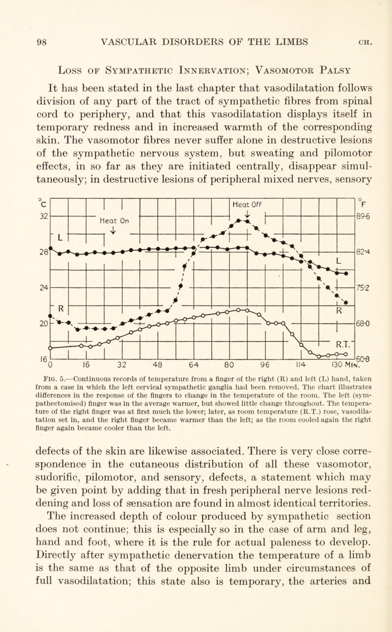 Loss of Sympathetic Innervation; Vasomotor Palsy It has been stated in the last chapter that vasodilatation follows division of any part of the tract of sympathetic fibres from spinal cord to periphery, and that this vasodilatation displays itself in temporary redness and in increased warmth of the corresponding skin. The vasomotor fibres never suffer alone in destructive lesions of the sympathetic nervous system, but sweating and pilomotor effects, in so far as they are initiated centrally, disappear simul¬ taneously; in destructive lesions of peripheral mixed nerves, sensory Fig. 5.-—Continuous records of temperature from a finger of the right (R) and left (L) hand, taken from a case in which the left cervical sympathetic ganglia had been removed. The chart illustrates differences in the response of the fingers to change in the temperature of the room. The left (sym- pathectomised) finger was in the average warmer, but showed little change throughout. The tempera¬ ture of the right finger was at first much the lower; later, as room temperature (R.T.) rose, vasodila¬ tation set in, and the right finger became warmer than the left; as the room cooled again the right finger again became cooler than the left. defects of the skin are likewise associated. There is very close corre¬ spondence in the cutaneous distribution of all these vasomotor, sudorific, pilomotor, and sensory, defects, a statement which may be given point by adding that in fresh peripheral nerve lesions red¬ dening and loss of sensation are found in almost identical territories. The increased depth of colour produced by sympathetic section does not continue; this is especially so in the case of arm and leg, hand and foot, where it is the rule for actual paleness to develop. Directly after sympathetic denervation the temperature of a limb is the same as that of the opposite limb under circumstances of full vasodilatation; this state also is temporary, the arteries and