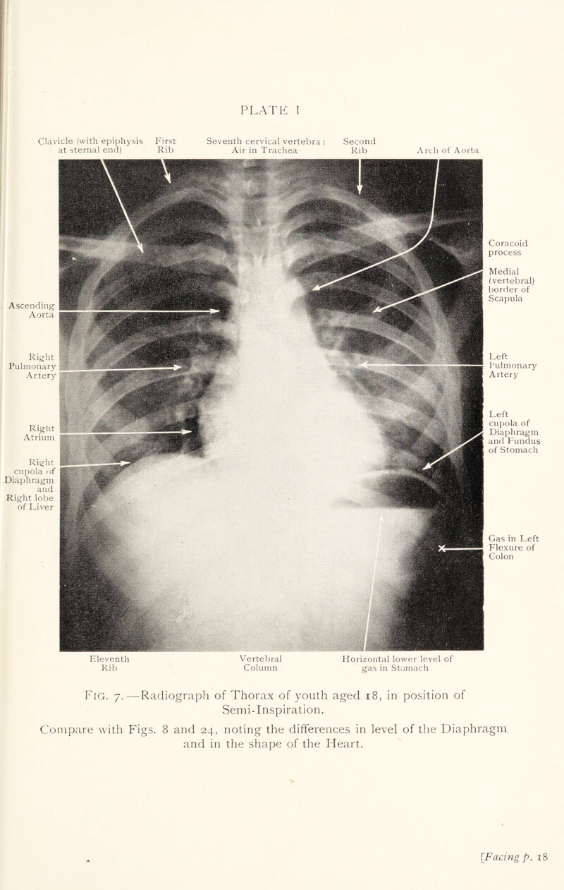 PLATE I Clavicle (with epiphysis First Seventh cervical vertebra: Second at sternal end) Rib Air in Trachea Rib Arch of Aorta Ascending Aorta Right Pulmonary Artery Right Atrium Right cupola of Diaphragm and Right lobe of Liver Coracoid process Medial (vertebral) border of Scapula Left Pulmonary Artery Left cupola of Diaphragm and Fundus of Stomach Gas in Left Flexure of Colon Eleventh Rib Vertebral Horizontal lower level of Column gas in Stomach Fig. 7.—Radiograph of Thorax of youth aged 18, in position of Semi-Inspiration. Compare with Figs. 8 and 24, noting the differences in level of the Diaphragm and in the shape of the Heart. [Facing p. 18