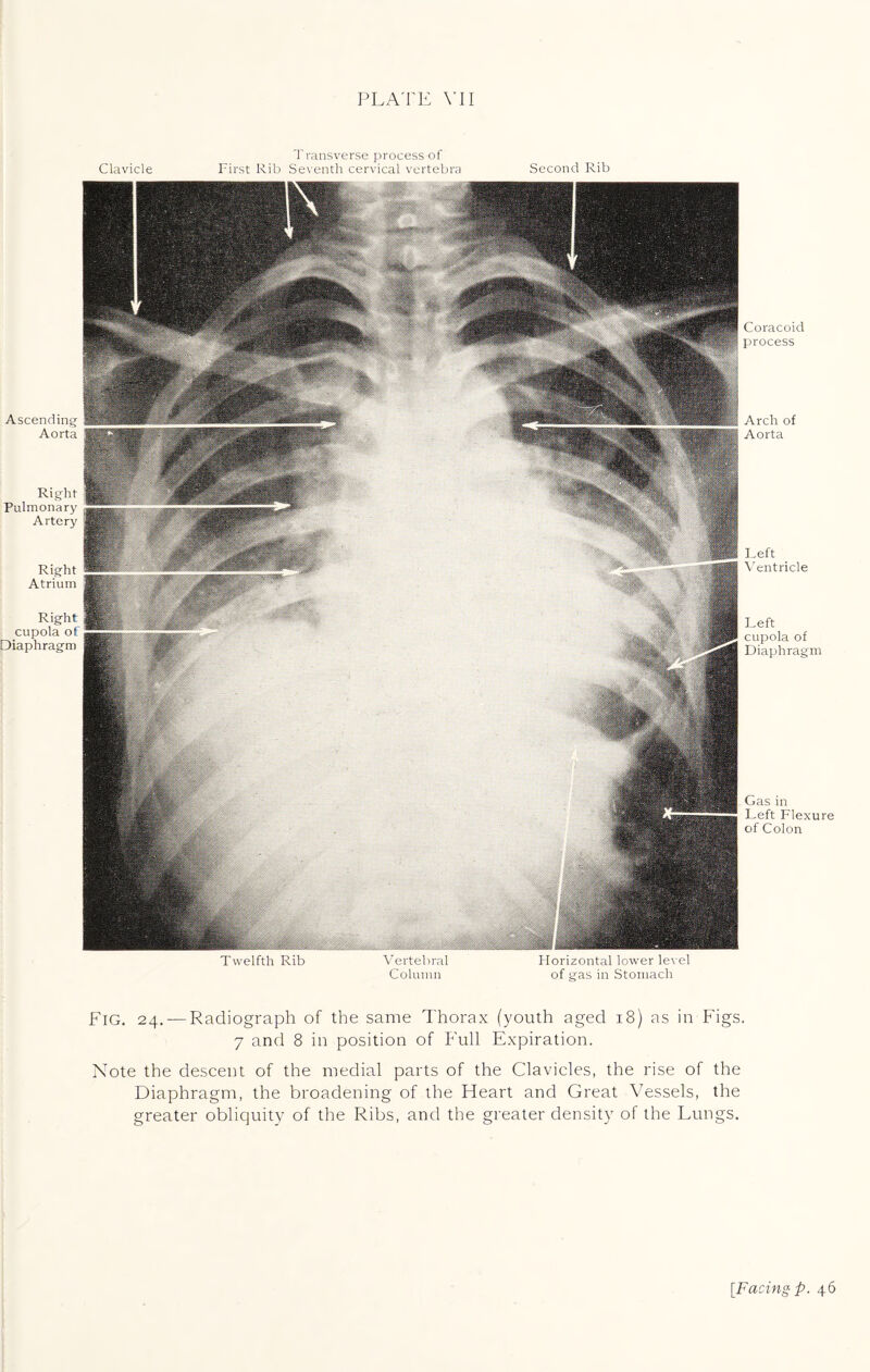 Ascending Aorta Right Pulmonary Artery Right Atrium Right cupola of Diaphragm Transverse process of Clavicle First Rib Seventh cervical vertebra Second Rib Twelfth Rib Vertebral Horizontal lower level Column of gas in Stomach Fig. 24.— Radiograph of the same Thorax (youth aged 18) as in Figs 7 and 8 in position of Full Expiration. Note the descent of the medial parts of the Clavicles, the rise of the Diaphragm, the broadening of the Heart and Great Vessels, the greater obliquity of the Ribs, and the greater density of the Lungs. Coracoid process Arch of Aorta Reft V entricle Reft cupola of Diaphragm Gas in Reft Flexure of Colon [Facing p. 46