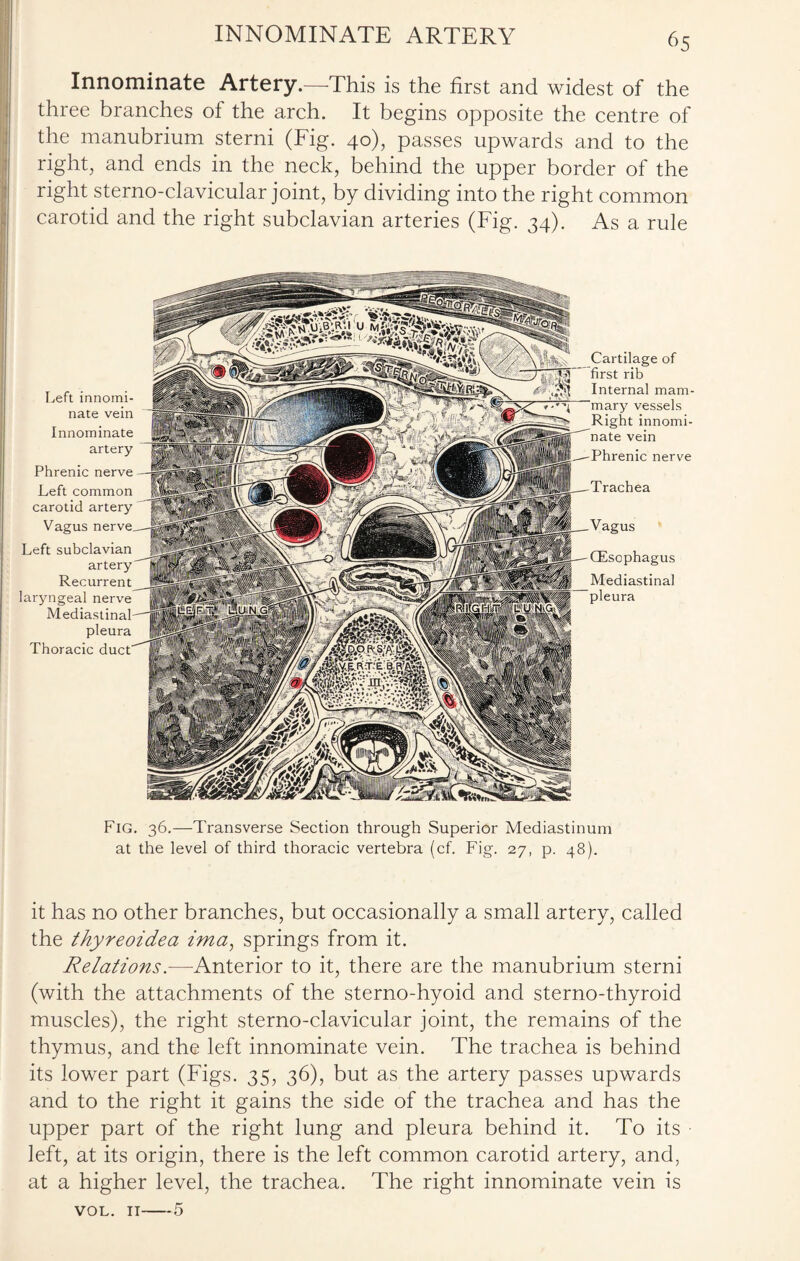 INNOMINATE ARTERY Innominate Artery.—This is the first and widest of the three branches of the arch. It begins opposite the centre of the manubrium sterni (Fig. 40), passes upwards and to the right, and ends in the neck, behind the upper border of the right sterno-clavicular joint, by dividing into the right common carotid and the right subclavian arteries (Fig. 34). As a rule Left innomi¬ nate vein Innominate artery Phrenic nerve Left common carotid artery Vagus Left subclavian artery Recurrent laryngeal nerve Mediastinal pleura Thoracic Trachea Vagus (Esophagus Mediastinal pleura Cartilage of first rib Internal mam- vessels innomi¬ nate vein Phrenic nerve Fig. 36.—Transverse Section through Superior Mediastinum at the level of third thoracic vertebra (cf. Fig. 27, p. 48). it has no other branches, but occasionally a small artery, called the thyreoidea ima, springs from it. Relations.—Anterior to it, there are the manubrium sterni (with the attachments of the sterno-hyoid and sterno-thyroid muscles), the right sterno-clavicular joint, the remains of the thymus, and the left innominate vein. The trachea is behind its lower part (Figs. 35, 36), but as the artery passes upwards and to the right it gains the side of the trachea and has the upper part of the right lung and pleura behind it. To its left, at its origin, there is the left common carotid artery, and, at a higher level, the trachea. The right innominate vein is 5 VOL. II