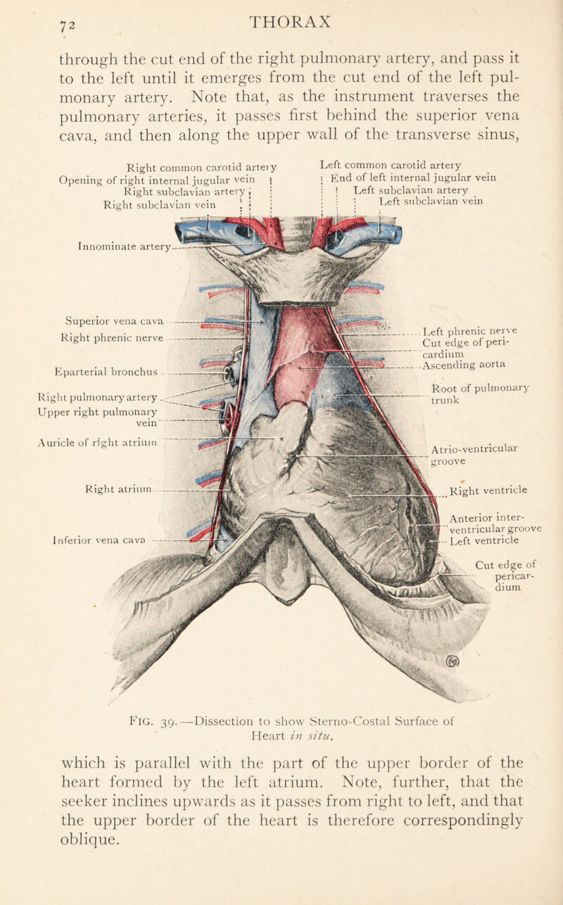 through the cut end of the right pulmonary artery, and pass it to the left until it emerges from the cut end of the left pul¬ monary artery. Note that, as the instrument traverses the pulmonary arteries, it passes first behind the superior vena cava, and then along the upper wall of the transverse sinus, Innominate artery Superior vena cava Right phrenic nerve Eparterial bronchus - Right pulmonary artery. Upper right pulmonary vein' Auricle of right atrium Right atrium Inferior vena cava Left phrenic nerve Cut edge of peri¬ cardium Ascending aorta Root of pulmonary trunk A trio-ventricular groove .Right ventricle Anterior mter-  ventricular groove -• Left ventricle Cut edge of pericar¬ dium Right common carotid artery Opening of right internal jugular vein i Right subclavian artery j Right subclavian vein Left common carotid artery ; End of left internal jugular vein : ! Left subclavian artery Left subclavian vein Fig. 39.—Dissection to show Sterno-Costal Surface of Heart in situ. which is parallel with the part of the upper border of the heart formed by the left atrium. Note, further, that the seeker inclines upwards as it passes from right to left, and that the upper border of the heart is therefore correspondingly oblique.