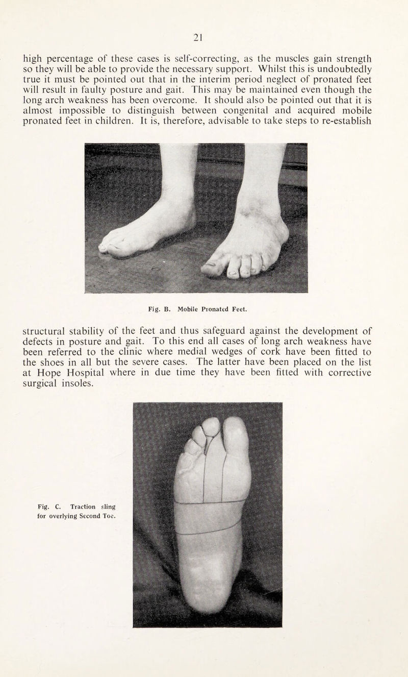 high percentage of these cases is self-correcting, as the muscles gain strength so they will be able to provide the necessary support. Whilst this is undoubtedly true it must be pointed out that in the interim period neglect of pronated feet will result in faulty posture and gait. This may be maintained even though the long arch weakness has been overcome. It should also be pointed out that it is almost impossible to distinguish between congenital and acquired mobile pronated feet in children. It is, therefore, advisable to take steps to re-establish Fig. B. Mobile Pronated Feet. structural stability of the feet and thus safeguard against the development of defects in posture and gait. To this end all cases of long arch weakness have been referred to the clinic where medial wedges of cork have been fitted to the shoes in all but the severe cases. The latter have been placed on the list at Hope Hospital where in due time they have been fitted with corrective surgical insoles. Fig. C. Traction sling for overlying Second Toe.