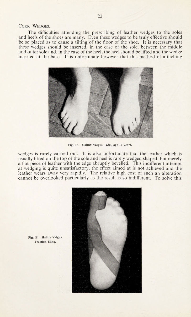 Cork Wedges. The difficulties attending the prescribing of leather wedges to the soles and heels of the shoes are many. Even these wedges to be truly effective should be so placed as to cause a tilting of the floor of the shoe. It is necessary that these wedges should be inserted, in the case of the sole5 between the middle and outer sole and, in the case of the heel, the heel should be lifted and the wedge inserted at the base. It is unfortunate however that this method of attaching Fig. D. Hallux Valgus—Girl, age 11 years. wedges is rarely carried out. It is also unfortunate that the leather which is usually fitted on the top of the sole and heel is rarely wedged shaped, but merely a flat piece of leather with the edge abruptly bevelled. This indifferent attempt at wedging is quite unsatisfactory, the effect aimed at is not achieved and the leather wears away very rapidly. The relative high cost of such an alteration cannot be overlooked particularly as the result is so indifferent. To solve this Fig. E. Hallux Valgus Traction Sling.