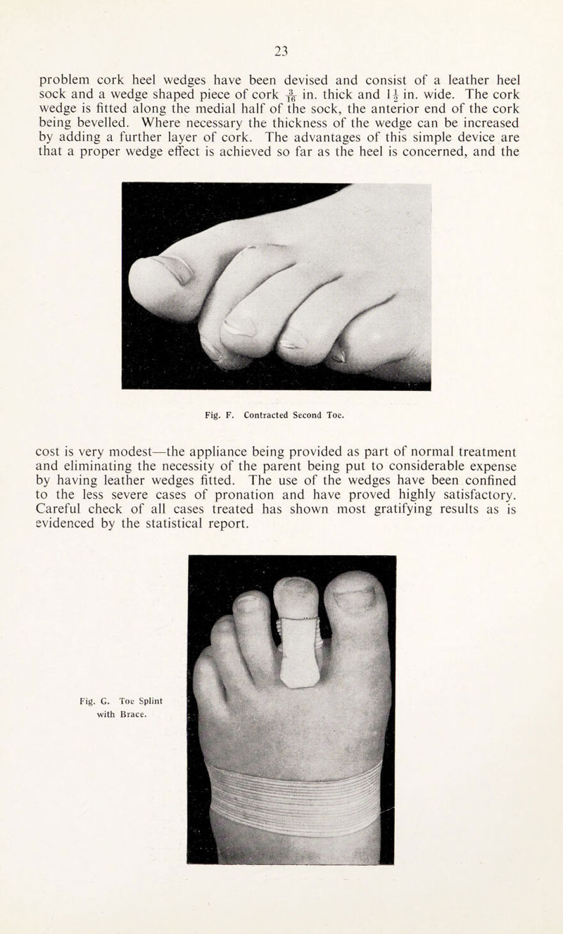 problem cork heel wedges have been devised and consist of a leather heel sock and a wedge shaped piece of cork ^ in. thick and 1J in. wide. The cork wedge is fitted along the medial half of the sock, the anterior end of the cork being bevelled. Where necessary the thickness of the wedge can be increased by adding a further layer of cork. The advantages of this simple device are that a proper wedge effect is achieved so far as the heel is concerned, and the Fig. F. Contracted Second Toe. cost is very modest—the appliance being provided as part of normal treatment and eliminating the necessity of the parent being put to considerable expense by having leather wedges fitted. The use of the wedges have been confined to the less severe cases of pronation and have proved highly satisfactory. Careful check of all cases treated has shown most gratifying results as is evidenced by the statistical report. Fig. G. Toe Splint with Brace.