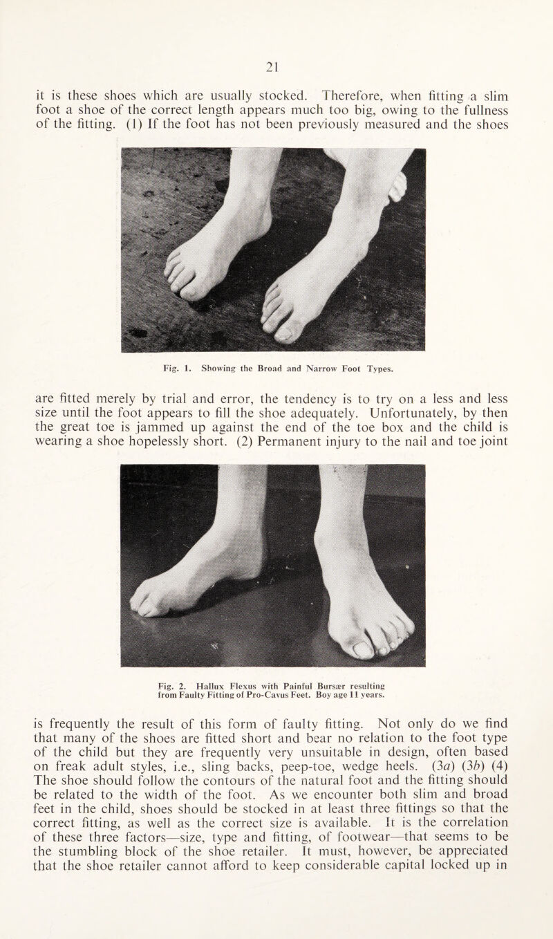 it is these shoes which are usually stocked. Therefore, when fitting a slim foot a shoe of the correct length appears much too big, owing to the fullness of the fitting. (1) If the foot has not been previously measured and the shoes Fig. 1. Showing the Broad and Narrow Foot Types. are fitted merely by trial and error, the tendency is to try on a less and less size until the foot appears to fill the shoe adequately. Unfortunately, by then the great toe is jammed up against the end of the toe box and the child is wearing a shoe hopelessly short. (2) Permanent injury to the nail and toe joint Fig. 2. Hallux Flexus with Painful Bursaer resulting from Faulty Fitting of Pro-Cavus Feet. Boy age 11 years. is frequently the result of this form of faulty fitting. Not only do we find that many of the shoes are fitted short and bear no relation to the foot type of the child but they are frequently very unsuitable in design, often based on freak adult styles, i.e., sling backs, peep-toe, wedge heels. (3a) (3b) (4) The shoe should follow the contours of the natural foot and the fitting should be related to the width of the foot. As we encounter both slim and broad feet in the child, shoes should be stocked in at least three fittings so that the correct fitting, as well as the correct size is available. It is the correlation of these three factors—size, type and fitting, of footwear—that seems to be the stumbling block of the shoe retailer. It must, however, be appreciated that the shoe retailer cannot afford to keep considerable capital locked up in