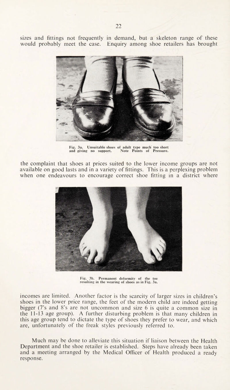 sizes and fittings not frequently in demand, but a skeleton range of these would probably meet the case. Enquiry among shoe retailers has brought Fig. 3a. Unsuitable shoes of adult type much too short and giving no support. Note Points of Pressure. the complaint that shoes at prices suited to the lower income groups are not available on good lasts and in a variety of fittings. This is a perplexing problem when one endeavours to encourage correct shoe fitting in a district where Fig. 3b. Permanent deformity of the toe resulting in the wearing of shoes as in Fig. 3a. incomes are limited. Another factor is the scarcity of larger sizes in children’s shoes in the lower price range, the feet of the modern child are indeed getting bigger (7’s and 8’s are not uncommon and size 6 is quite a common size in the 11-13 age group). A further disturbing problem is that many children in this age group tend to dictate the type of shoes they prefer to wear, and which are, unfortunately of the freak styles previously referred to. Much may be done to alleviate this situation if liaison between the Health Department and the shoe retailer is established. Steps have already been taken and a meeting arranged by the Medical Officer of Health produced a ready response.