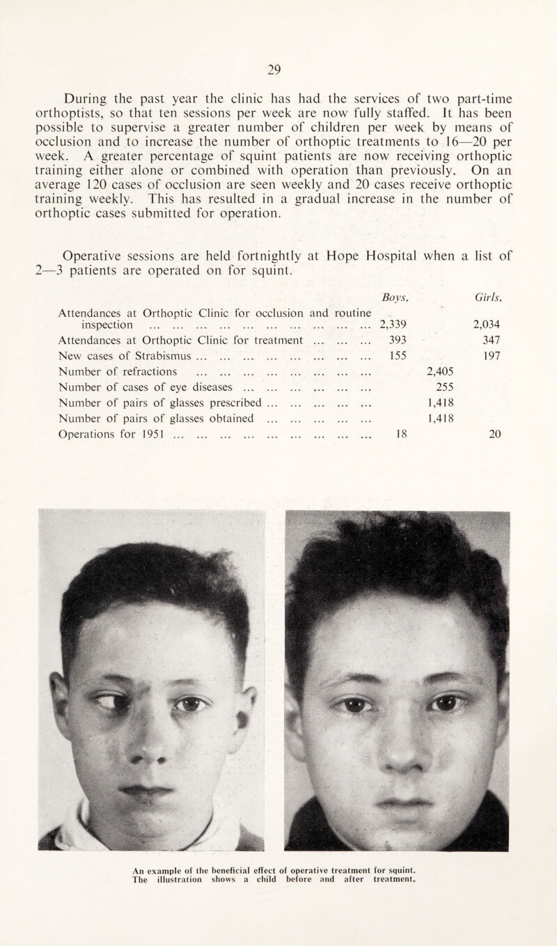 During the past year the clinic has had the services of two part-time orthoptists, so that ten sessions per week are now fully staffed. It has been possible to supervise a greater number of children per week by means of occlusion and to increase the number of orthoptic treatments to 16—20 per week. A greater percentage of squint patients are now receiving orthoptic training either alone or combined with operation than previously. On an average 120 cases of occlusion are seen weekly and 20 cases receive orthoptic training weekly. This has resulted in a gradual increase in the number of orthoptic cases submitted for operation. Operative sessions are held fortnightly at Hope Hospital 3 patients are operated on for squint. when a list of Boys. Girls. Attendances at Orthoptic Clinic for occlusion and routine inspection . 2,339 2,034 Attendances at Orthoptic Clinic for treatment . 393 347 New cases of Strabismus. Number of refractions . 155 2,405 197 Number of cases of eye diseases . .. 255 Number of pairs of glasses prescribed. 1,418 Number of pairs of glasses obtained . Operations for 1951 . 18 1,418 20 An example of the beneficial effect of operative treatment for squint. The illustration shows a child before and after treatment.