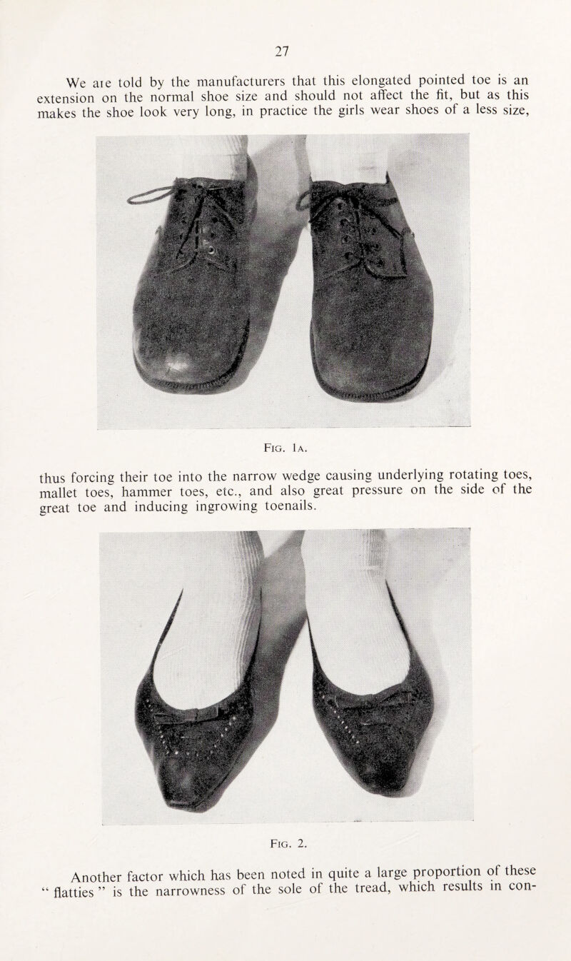 We are told by the manufacturers that this elongated pointed toe is an extension on the normal shoe size and should not affect the fit, but as this makes the shoe look very long, in practice the girls wear shoes of a less size, Fig. 1a. thus forcing their toe into the narrow wedge causing underlying rotating toes, mallet toes, hammer toes, etc., and also great pressure on the side of the great toe and inducing ingrowing toenails. Fig. 2. Another factor which has been noted in quite a large proportion of these “ flatties ” is the narrowness of the sole of the tread., which results in con-