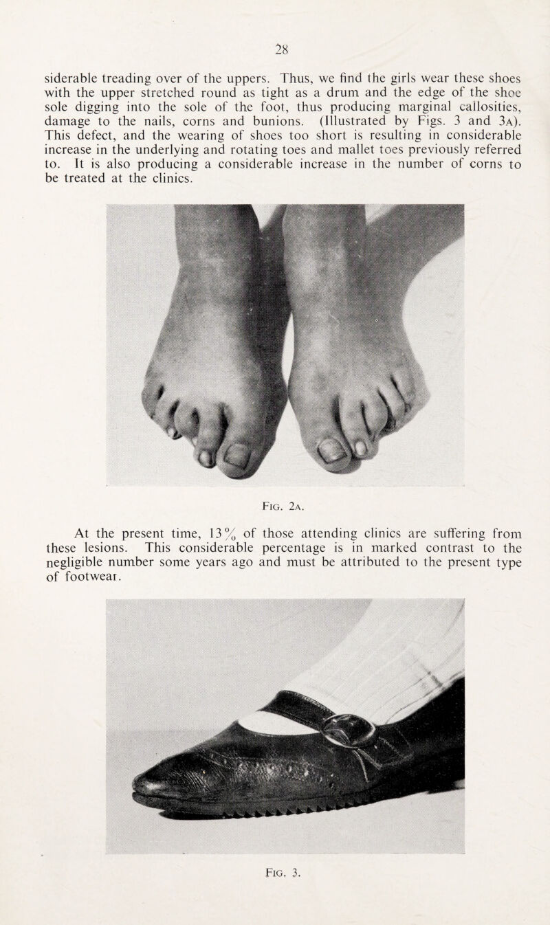 siderable treading over of the uppers. Thus, we find the girls wear these shoes with the upper stretched round as tight as a drum and the edge of the shoe sole digging into the sole of the foot, thus producing marginal callosities, damage to the nails, corns and bunions. (Illustrated by Figs. 3 and 3a). This defect, and the wearing of shoes too short is resulting in considerable increase in the underlying and rotating toes and mallet toes previously referred to. It is also producing a considerable increase in the number of corns to be treated at the clinics. Fig. 2a. At the present time, 13% of those attending clinics are suffering from these lesions. This considerable percentage is in marked contrast to the negligible number some years ago and must be attributed to the present type of footwear. Tig, 3.