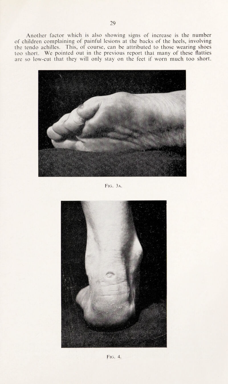 Another factor which is also showing signs of increase is the number of children complaining of painful lesions at the backs of the heels, involving the tendo achilles. This, of course, can be attributed to those wearing shoes too short. We pointed out in the previous report that many of these flatties are so low-cut that they will only stay on the feet if worn much too short. Fig. 3a.