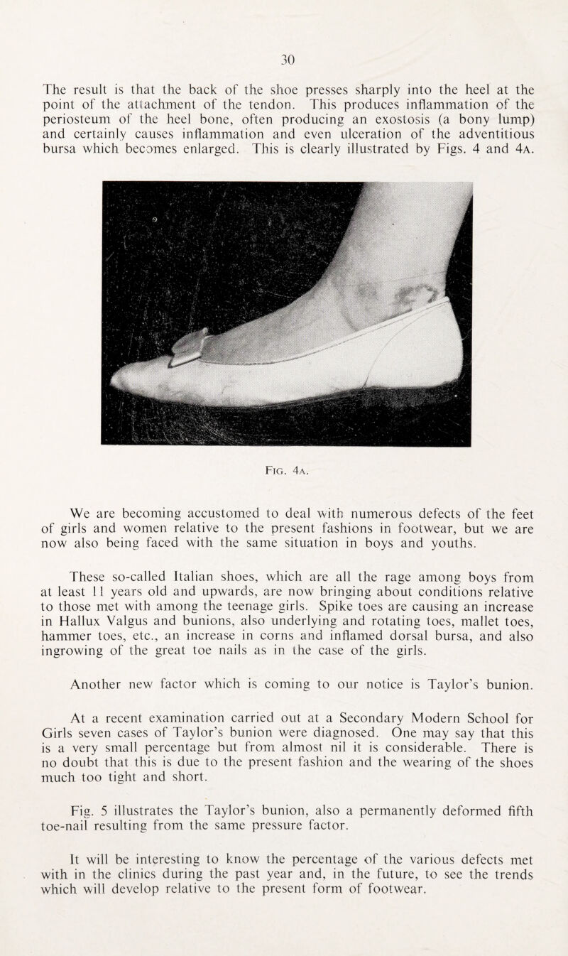 The result is that the back of the shoe presses sharply into the heel at the point of the attachment of the tendon. This produces inflammation of the periosteum of the heel bone, often producing an exostosis (a bony lump) and certainly causes inflammation and even ulceration of the adventitious bursa which becomes enlarged. This is clearly illustrated by Figs. 4 and 4a. Fig. 4a. We are becoming accustomed to deal with numerous defects of the feet of girls and women relative to the present fashions in footwear, but we are now also being faced with the same situation in boys and youths. These so-called Italian shoes, which are all the rage among boys from at least 11 years old and upwards, are now bringing about conditions relative to those met with among the teenage girls. Spike toes are causing an increase in Hallux Valgus and bunions, also underlying and rotating toes, mallet toes, hammer toes, etc., an increase in corns and inflamed dorsal bursa, and also ingrowing of the great toe nails as in the case of the girls. Another new factor which is coming to our notice is Taylor’s bunion. At a recent examination carried out at a Secondary Modern School for Girls seven cases of Taylor’s bunion were diagnosed. One may say that this is a very small percentage but from almost nil it is considerable. There is no doubt that this is due to the present fashion and the wearing of the shoes much too tight and short. Fig. 5 illustrates the Taylor’s bunion, also a permanently deformed fifth toe-nail resulting from the same pressure factor. It will be interesting to know the percentage of the various defects met with in the clinics during the past year and, in the future, to see the trends which will develop relative to the present form of footwear,