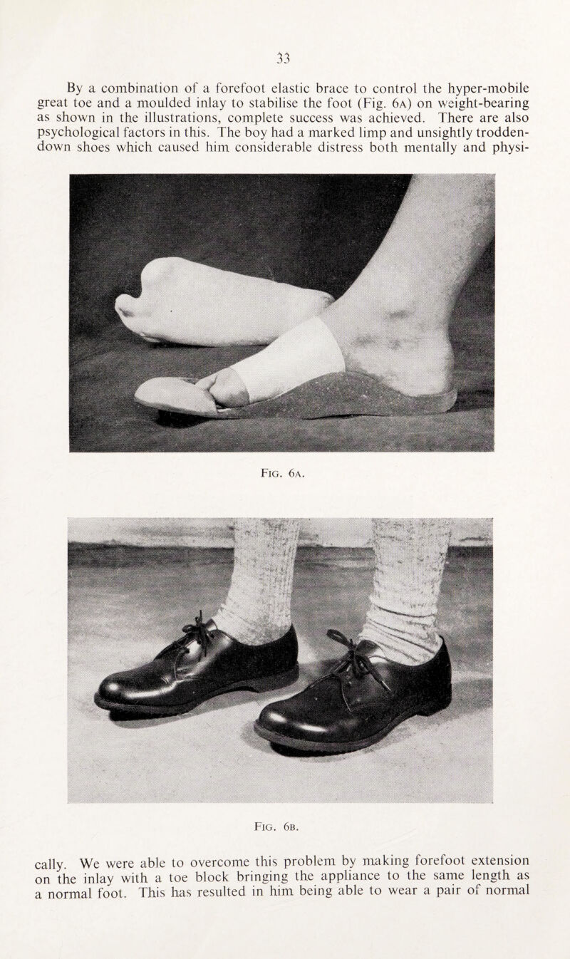 By a combination of a forefoot elastic brace to control the hyper-mobile great toe and a moulded inlay to stabilise the foot (Fig. 6a) on weight-bearing as shown in the illustrations, complete success was achieved. There are also psychological factors in this. The boy had a marked limp and unsightly trodden- down shoes which caused him considerable distress both mentally and physi- Fig. 6a. Fig. 6b. cally. We were able to overcome this problem by making forefoot extension on the inlay with a toe block bringing the appliance to the same length as a normal foot. This has resulted in him being able to wear a pair of normal