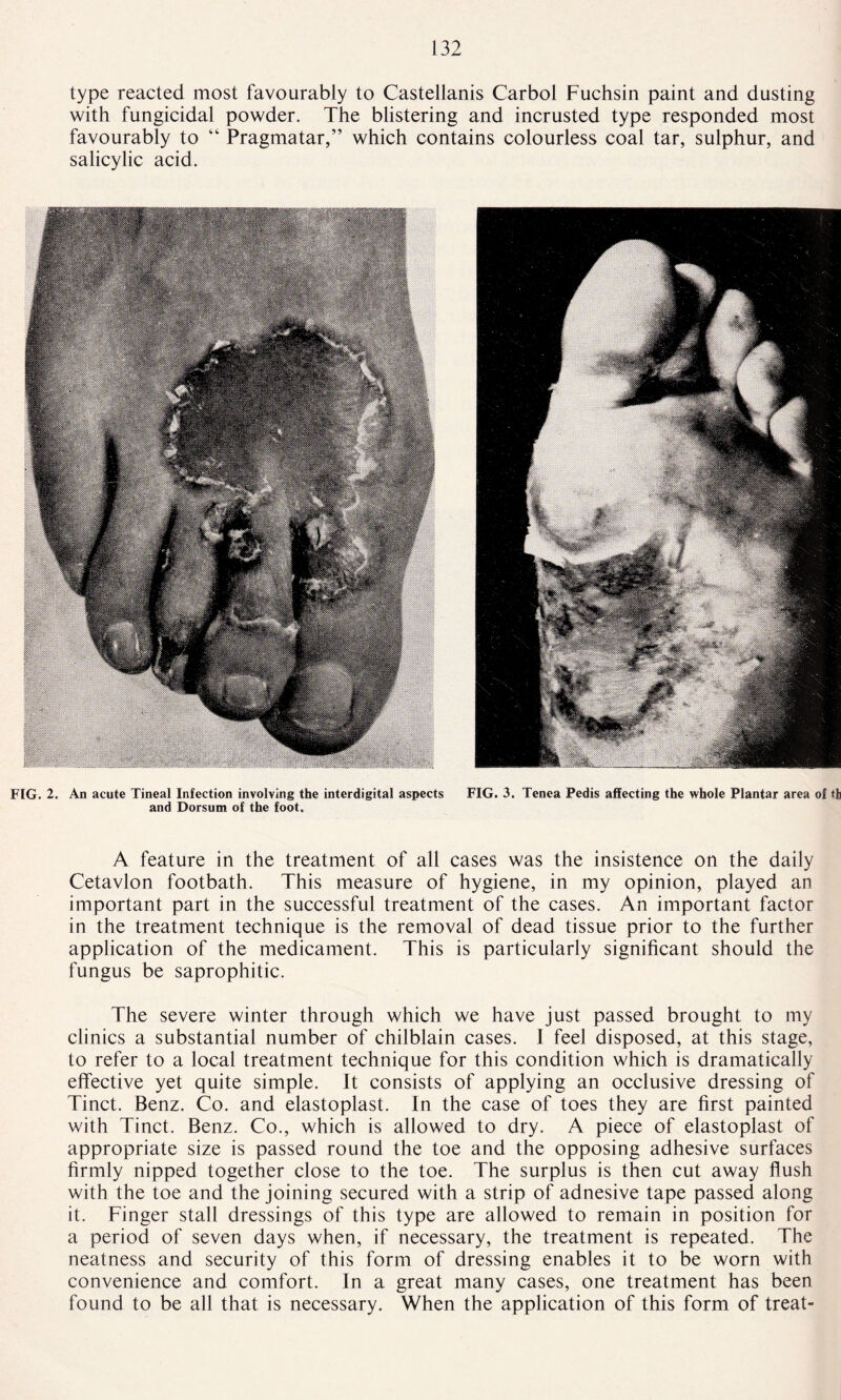 type reacted most favourably to Castellanis Carbol Fuchsin paint and dusting with fungicidal powder. The blistering and incrusted type responded most favourably to “ Pragmatar,” which contains colourless coal tar, sulphur, and salicylic acid. FIG. 2. An acute Tineal Infection involving the interdigital aspects FIG. 3. Tenea Pedis affecting the whole Plantar area of fh and Dorsum of the foot. A feature in the treatment of all cases was the insistence on the daily Cetavlon footbath. This measure of hygiene, in my opinion, played an important part in the successful treatment of the cases. An important factor in the treatment technique is the removal of dead tissue prior to the further application of the medicament. This is particularly significant should the fungus be saprophitic. The severe winter through which we have just passed brought to my clinics a substantial number of chilblain cases. 1 feel disposed, at this stage, to refer to a local treatment technique for this condition which is dramatically effective yet quite simple. It consists of applying an occlusive dressing of Tinct. Benz. Co. and elastoplast. In the case of toes they are first painted with Tinct. Benz. Co., which is allowed to dry. A piece of elastoplast of appropriate size is passed round the toe and the opposing adhesive surfaces firmly nipped together close to the toe. The surplus is then cut away flush with the toe and the joining secured with a strip of adnesive tape passed along it. Finger stall dressings of this type are allowed to remain in position for a period of seven days when, if necessary, the treatment is repeated. The neatness and security of this form of dressing enables it to be worn with convenience and comfort, in a great many cases, one treatment has been found to be all that is necessary. When the application of this form of treat-