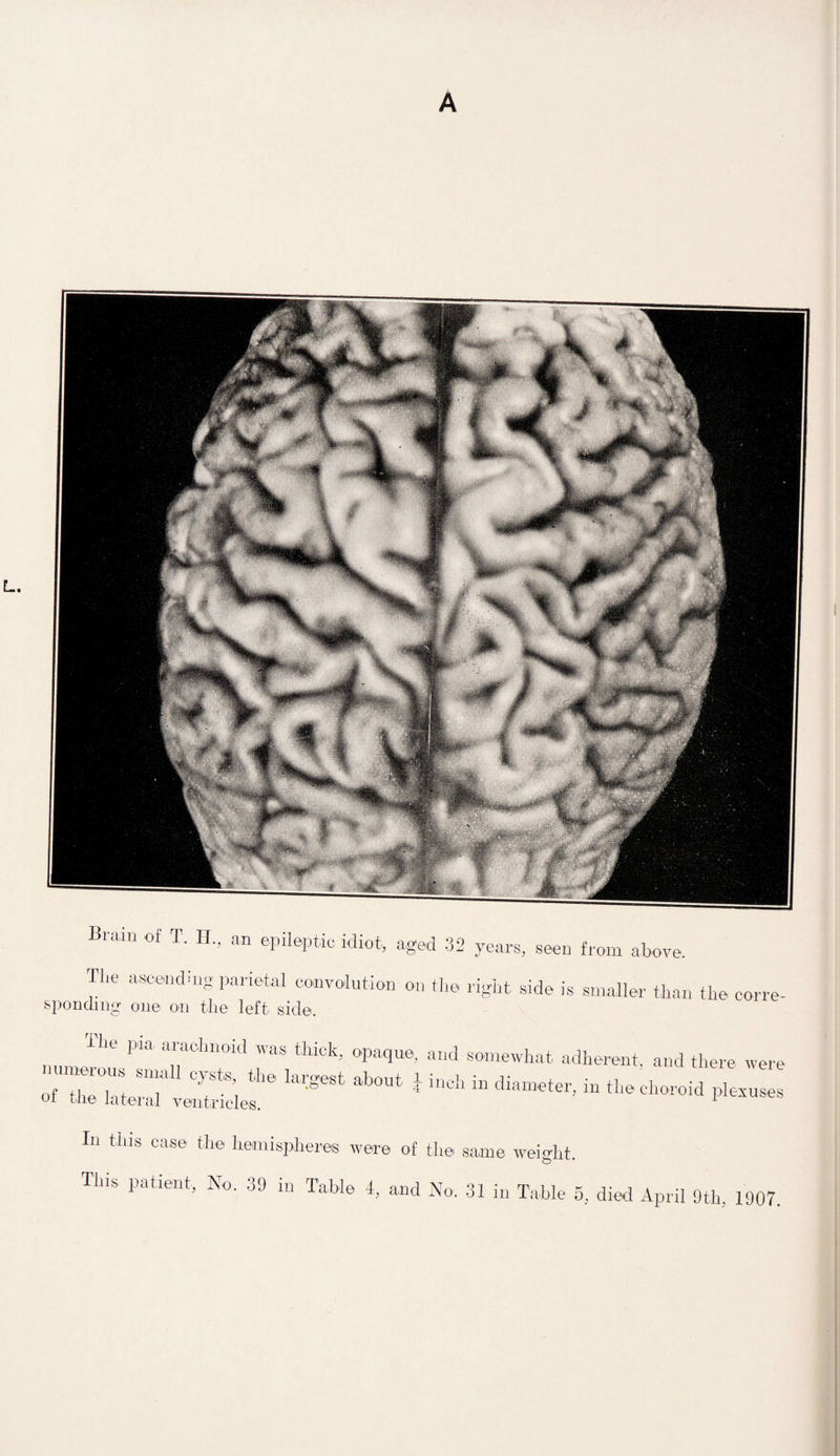 A L. Brain of T. II., an epileptic idiot, aged 32 years, seen from above. The ascending parietal convolution on the right side is smaller than the corre- spending one on the left side. The pda arachnoid was thick, opaque, and somewhat adherent, and there were “ztrir ■——* - - *—• -«*—r.™ Ill this case the hemispheres were of the same weight,