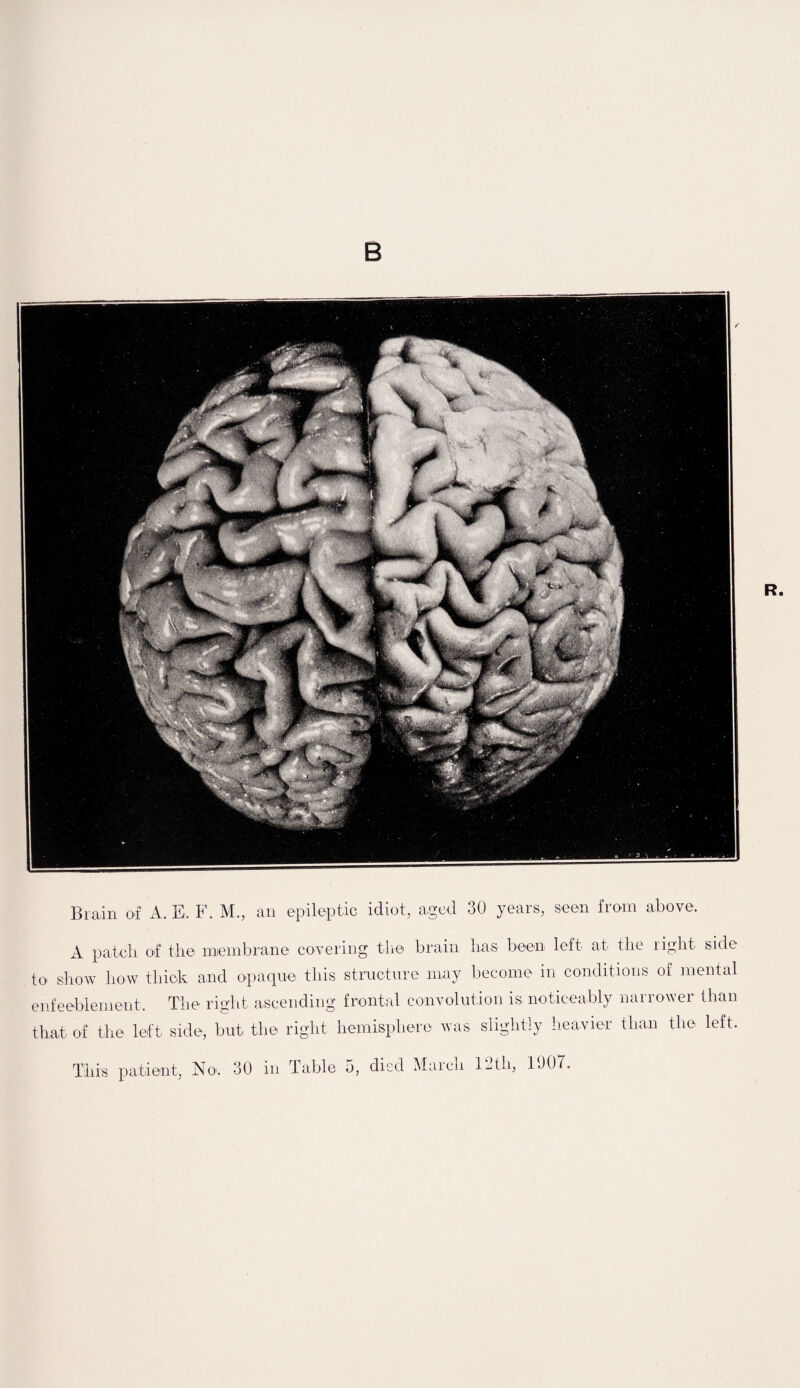 Brain of A. E, F. M., an epileptic idiot, aged 30 years, seen from above. A patch, of the membrane covering the brain Iras been left at the light side to show how thick and opaque this structure may become in conditions of mental enfeeblement. The right ascending frontal convolution is noticeably narrower than that of the left side, but the right hemisphere was slightly heavier than the left. This patient, No>. 30 in
