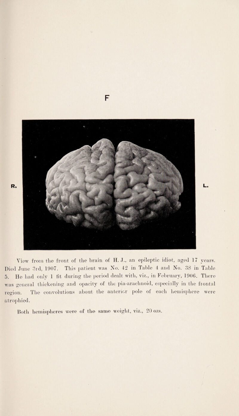 F R» L, View from the front of the brain of H. J., an epileptic idiot, aged IT years. Died June 3rd, 1907. This patient was No. 42 in Table 4 and No. 38 in Table 5. He had only 1 fit during the period dealt with, viz., in February, 1906. There was general thickening and opacity of the pia-arachnoid, especially in the frontal region. The convolutions about the anterior pole of each hemisphere were atrophied. Both hemispheres were of the same weight, viz., 20 ozs.