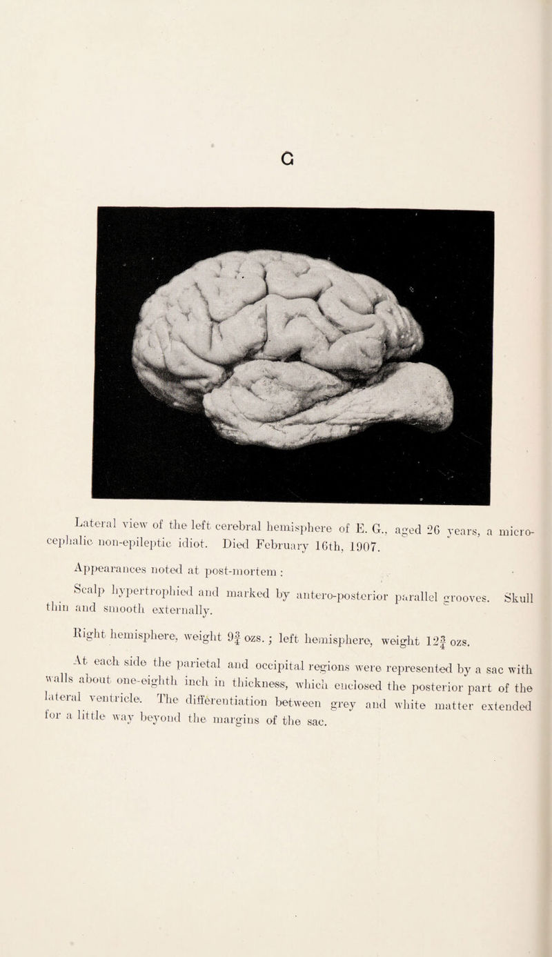 c Lateral view of the left cerebral hemisphere of E. G., aged 26 years, a micro- cephalic non-epileptic idiot. Died February 16th, 1907. Appearances noted at post-mortem : Scalp hypertrophied and marked by antero-posterior parallel grooves. Skull thin and smooth externally. Right hemisphere, weight 9f ozs.; left hemisphere, weight 12} ozs. At each side the parietal and occipital regions were represented by a sac with walls about one-eighth inch in thickness, which enclosed the posterior part of the Idteial ventricle. The differentiation between grey and white matter extended f nv o l.‘h hi,. _ 1 i for a little way beyond the- margins of the sac.