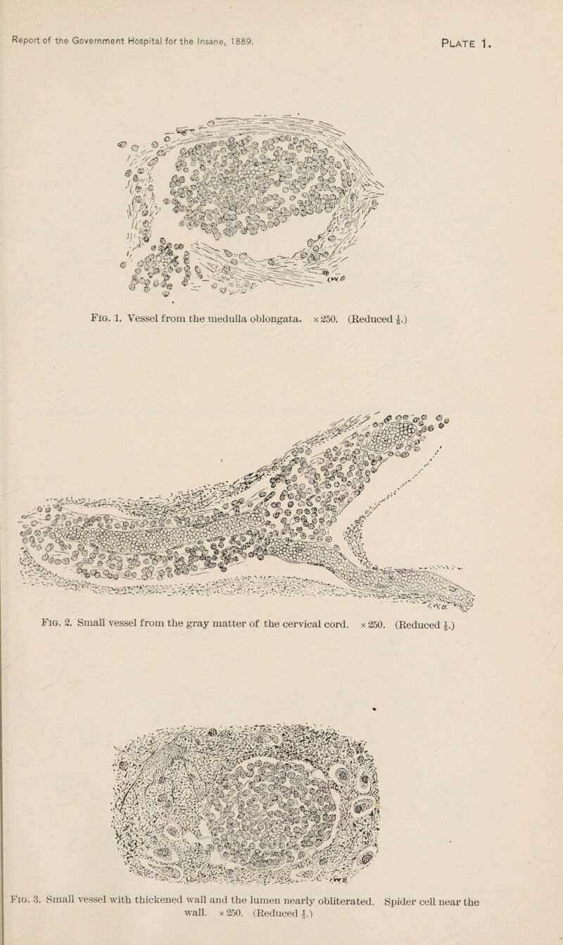 Fig. 2. Small vessel from the gray matter of the cervical cord, x 250. (Reduced £.) Fig. 3. Small vessel with thickened wall and the lumen nearly obliterated. Spider cell near the wall, x 250. (Reduced £.)