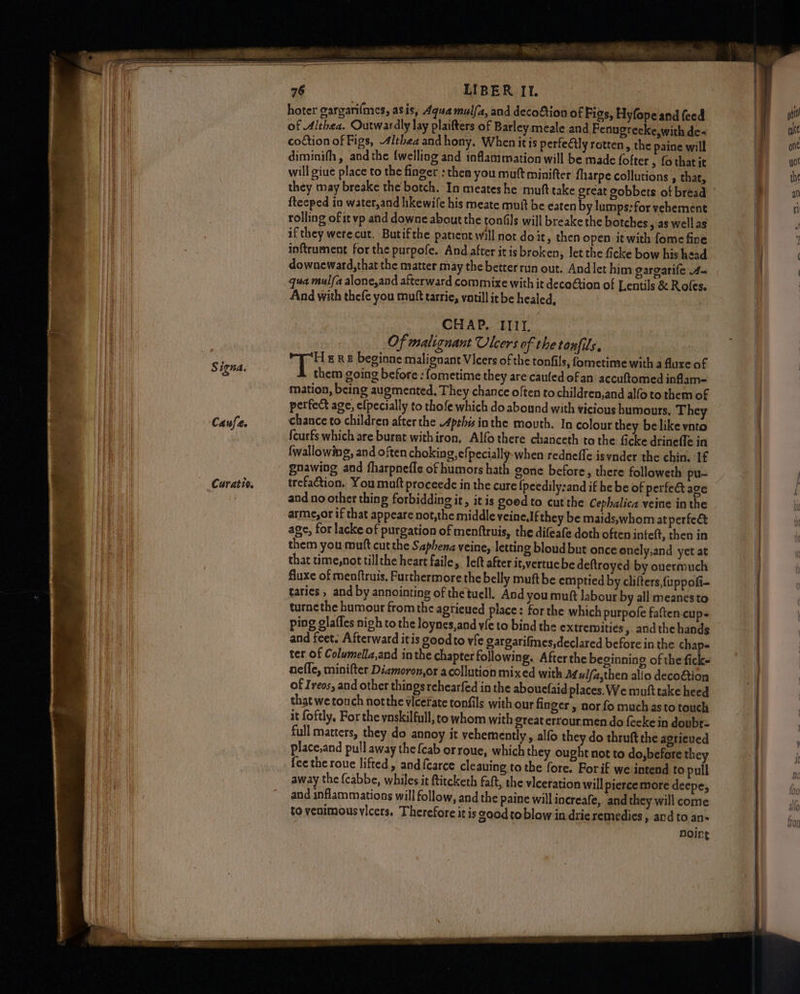 Caufe. Sipe: See 76 LIBER Il. hoter gargarifmes, asis, Aqua mulfa, and decoftion of Figs, Hyfopeand feed of Althea. Outwardly lay plaifters of Barley meale and Fenugrecke,with de« coction of Figs, 4ithea andhony. When itis perfeétly rotten, the paine will diminifh , andthe {welling and inflammation will be made fofter , fo thatit will giue place to the finger : then you mutt minifter fharpe collutions , that, they may breake the botch. In meates he muft take great gobbets of bread ftecped in water,and hkewife his meate muit be eaten by lumps:for vehement if they werecut. Butifthe patient will not doit, then open itwith fome fine inftrument forthe purpofe. And after it is broken, let the ficke bow his head downeward,that the matter may the betterrun out. Andlet him gargatife 4- qua mulfa alone,and afterward commixe with it decoCtion of Lentils & Rofes. And with thefe you muft tarrie, vatill it be healed, 3 CHAP. IIIT. Of malignant Ulcers of the tonfils. ee, E RE beginne malignant Vicers of the tonfils, fometime with a fuxe of them going before : fometime they are caufed ofan accuftomed inflam= mation, being augmented, They chance often to children,and alfo to them of perfect age, elpecially to thofe which do abound with vicious humours. They chance to children after the 4pthis inthe mouth. In colour they belike vnto fcurfs which are burat withiron, Alfo there chanceth to the ficke drineffe in fwallowing, and often choking, efpecially-when redneffe isvnder the chin. If gnawing and fharpnefie of humors hath gone before, there followeth pu- trefaction. You matt proceede in the cure {peedily:and if he be of perfet age and no other thing forbidding it, it is goed to cut the Cepbalica veine in the arme,or if that appeare not,the middle yeine.If they be maids,whom at perfect age, for lacke of purgation of menftruis, the difeafe doth often inteft, then in them you mutt cutthe Saphena veine, letting bloud but once onely,and yet at that time,not tillthe heart faile, left after it,vertuebe deftroyed by ouermuch fluxe of menftruis, Furthermore the belly muftbe emptied by clifters fuppofi- taries , and by annointing of thetuell. And you muft labour by all meanesto turnethe humour fromthe agrieued place: for the which purpofe faften cups ping glafles nigh to the loynes,and ve to bind the extremities » andthe hands and feet. Afterward itis goodto vfe gargarifmes,declared before in the chaps ter of Columella,and in the chapter following. After the beginning of the fick- nefle, minifter Diamoron,or acollution mixed with Mulfa,then alio decoé&tion of Ireos, and other things rehearfed in the aboucfaid places. We muft take heed that we touch notthe vicefate tonfils with our finger, nor fo much asto touch it foftly, For the ynskilfull, to whom with great errourmen do feeke in doubt full matters, they do annoy it vehemently, alfo they do thruft the agrieved place,and pull away the {cab orroue, which they ought not to do,befare the fee the roue lifted, and{carce cleauing to the fore. Forif we intend to pull away the {cabbe, whilesit ftitcketh faft, the vlceration will pierce more deepe, and inflammations will follow, and the paine will increafe, and they will come to venimousvicers. Therefore it is good toblow in drie remedies » and to an- noire