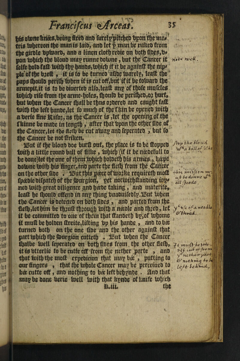 rcus 3* nab t% »* ^ ■ %fe otene foteea,being fireo ana fttrclppif tbeo fcpott the me*' trie tobcreon the mania laio, ana let $ man be nalteo from the girole bptoaro, ana a linen cloth rcoie on both ftoea.b* pon totjict) the blotto map runne ootone, but tbc Cancer it ■&** - felfe bolofafi toitb tbp banoa,lubicb if it be again® tbc nip*; pie'off be bjett , it ia to be f urnca afipe toarclp, lea® the' papa (boulo periflt tohcn if ia cut off,bat if it be totoaro tbe araiepit.it ia to be oiuerfeo alfo.leaC anp of tfjofc mnfdca lobicb rife from tbearme-bolea.fboulo be perifteo.oj bnrf* but toben tbe Cancer (ball be time ojaereo ana caagbt fa® toitb tbe left banoe,let fo much of tbe ¥ bin be openeo toitb . aberie fine Kafo?, as tbe Cancer ia ,tet tbe opening of tbe fbfnne be maae in length/after that bpon the otherfloe of the Cancer,let m atfy be cat atoap ana feperatea , bat To the Cancer be not ffrtbcn. H5nf If fbe blona ooe bur® onf, the place ia fobe ffoppea toitb a little roono bail of filbe, tobicb (if it be neeaefull to r be aonc)let tbeone oftberatoljtcbboloetbfjts armea, bapc aotone toifb bia ftiger^no parte the flelli from the Cancer ontbeotberfioe .• iSut tbia pace of too.il?e reqairefb mo® fpeeoic aifpatcb of the ^urgiort, pet ribttoitbttahoing top* % w neo toitb great Diligent gno beeoe Ming, ana niafcrtfe, lea® be (boniooffeno in imp thing bnaOMfeolp.JBuf toben the Canter taoefecteo on both fioea, ano parted from the fleflMetbtmbetb?u®thoughtoitba neeoleanotbjeo,let it be commifteo to one of them that ffanoeib bp,of tobome <y{rhr*A- it mn® be boloen ftreite,lifting bp bib banoe , ana to bee turneo both on the one Coe ana tbe other again® that part tobteb the Smrgion cuffetb . jlBut toben the Cancer tbalbe toell feperatea on both fioea from the other 8e®>» itiabfferlie to be entfe off front the nether parte , ano , iy that toitb the mo® erpeoicion that map bee, putting to %,%thJZjeZ «urfingera , that fbe tobote Cancer map be perceiueo to bee cutte off, ano nothing to bee left bebpnoe . Hno that map be oone berie toell toitb that bpnoe of knife tobicb ft.ttf the 'tike itf pn *«1 Ufht* tcL