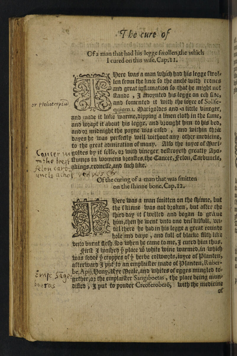 / ‘The curt of Of a man that had his legge fwollen.the which I cured on this wife.Cap.11, *' C or HUJ »£ perc tons a man tnfetctj fjao Ijis leggc ftoob n lien from the ttnee fo the antic toitb rcones great mflamation fo tijat ije might not ffanoe , 3 anognteo Iks legge on ccb ftoe, - '■* ana fomented it toitb the iogce of Soilfe- quium.i. sparigoloes anO «a little tonegcr, ano maoe it lithe toarme,nipping a linen doth in the fame, ano tojapt it about his legge, ano brought him to bis bco, anooi micnightthe pagne teas eafco , ano toithin thtee cages he t»as perfectlg todl toitljoutang other meoicine, to the great aomiration ofmang. £llfo the iugceof^arh Cm u e im vt soloes bg it felfe, oj toitb bincgcr oeflrogeth greatig £po* ■^r(,e U;vHumes in toorocns bjeattes.theCancer, jfelon,Carbuncle, jk Lo h c tu-o ^hings.reonelfe.ano fnch lifts. ■ biwc jo a cX<? i v t'd p? , ... Of the curing of a man that was fmitten ' on the lliinne bone,Cap. 12. ' l^ere teas a man fmitten on the !|inne, hut the Cfcinne teas not b’often, but after the thirooag it ftoellcD and began to gratae him,then he toent Onto one bnf htlfull, Dm till there be basin his legge a great rcunse bole ano ocepe , ano full of blacfte filth lilts bnfo burnt flefi).g>o tohen he cameto me,3 tureo him thus. ifirff 3 toaltjco {> place bo totjite toine toarmeo.in tuljich toas foooef croppies of § herbe coltocnjts.tugce ofpianten, aftcrtoaro 3 put to an emplaitter inaoe of pIanten,Ruber- r..... Vr . be,Aptj,lr)ong,ligc fpeale.ano toljites ofegges minglco to* f A :gether,oj the empiaifter Sangiboetas, the plate being mum oifico , $ put fo pouoer Creoferobero, toith the meoicine^ /