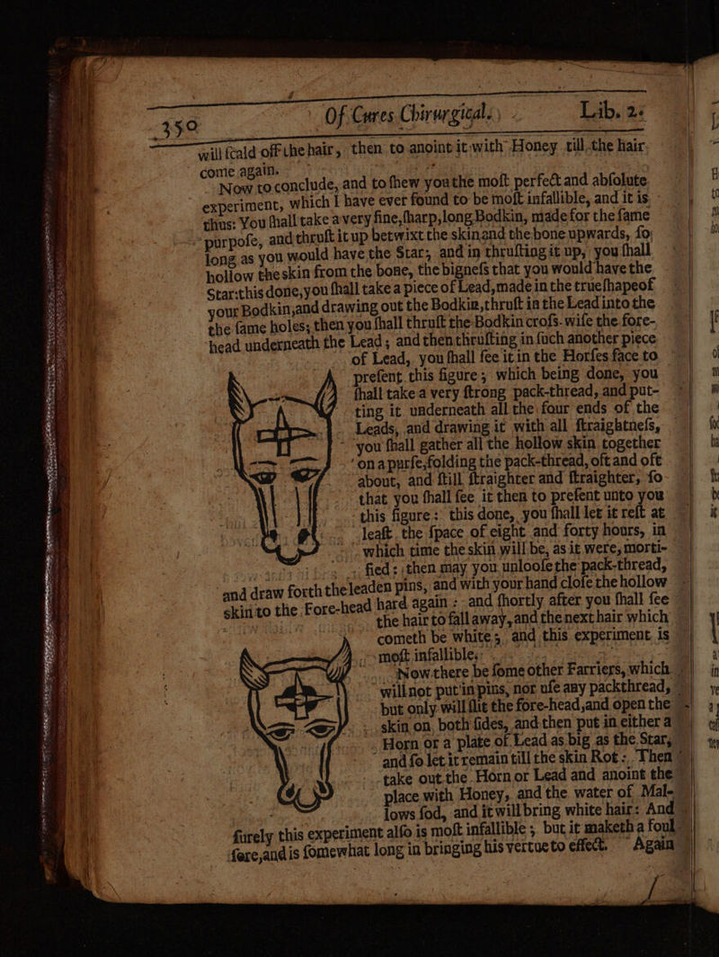 35,0 Of Cures Chirurgical. Lib. 2: will {cald off che hair, then to anoint it with Honey. till-the hair. come again. = ei oN ee a Now to conclude, and to fhew youthe molt. perfect and abfolute experiment, which I have ever found to be moft infallible, and it is thus: You fall take avery fine, fharp,long Bodkin, made for the fame > purpofe, and thruft itup betwixt the skinand the bone upwards, fo, jong as you would have the Star, and in thrufting it up, you fhall holiow the skin from the bone, the bignefs that you would have the Star-this done,you fhall take a piece of Lead,made in the truefhapeof your Bodkin,and drawing out the Bodkin, thruft ia the Lead into the the {ame holes; then you {hall thruft the Bodkin crofs- wite the fore- head underneath the Lead; and then thrufting in {uch another piece prefent this figure; which being done, you fhall take.a very ftrong pack-thread, and put- ‘ting it. underneath all the four ends of the Leads, and drawing it with all ftraightnefs, ‘on apurfe,folding the pack-thread, oft and oft about, and till ftraighter and ftraighter, fo that you hall fee it then to prefent unto you which time the skin will be, as it were, morti- vg ACEA BLES AOS )then may you. unloofe the pack-thread, ~ and draw forth the Jeaden pins, and with your hand clofe the hollow skin to the Fore-h | Sees cometh be white; and this experiment. is »smoft infallible... oat x rs