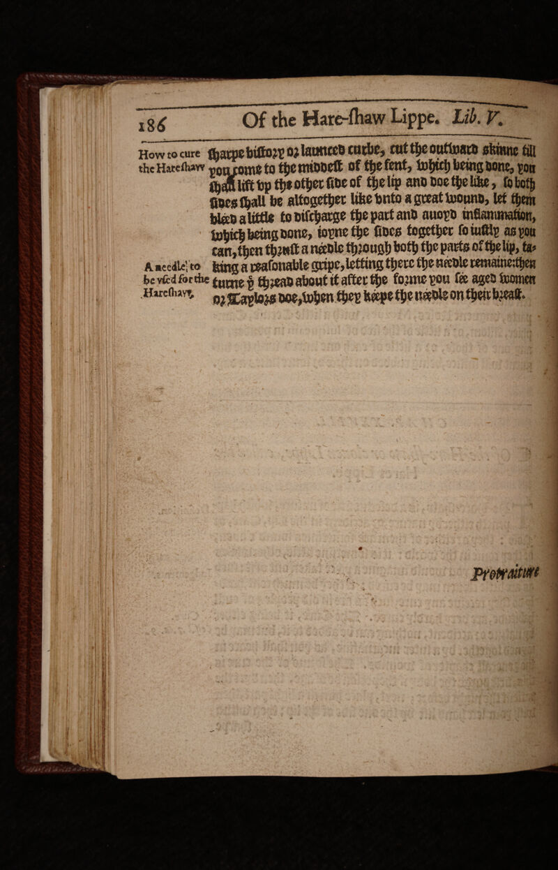      186 Of the Hare-fhaw Lippe. Lib. V, PEN ee ne casarrmmmeenenearinusnan UMMA EK I 607. 1/0 Ihc MOUND Ce Howto cure fharpe biftozy 02 launiced curbe, cut theoutinard skiune fill the Harethaw von come to theminnell of thefent, tobhiclh being none, yon {hall lift bp the other fide of thelip and docthelike, foboth fives thall be altogether like puto a great wound, let them bizd alittle to nifcharge the part and auopd méammeation, {wbich being pone, topne fhe fines together fotuttly as you cart, then thontt a needle through both the parts of thelip, fas Ancedlelto king a reafonable anipe, letting there the needle remanesthen be vied forthe tune § thea about it after the forme you fe aged ioomen Harchhay, 9 graplogs poe, when they heepe the negole on thei beak. Oe a a Prowraitve - lei i - ie: a