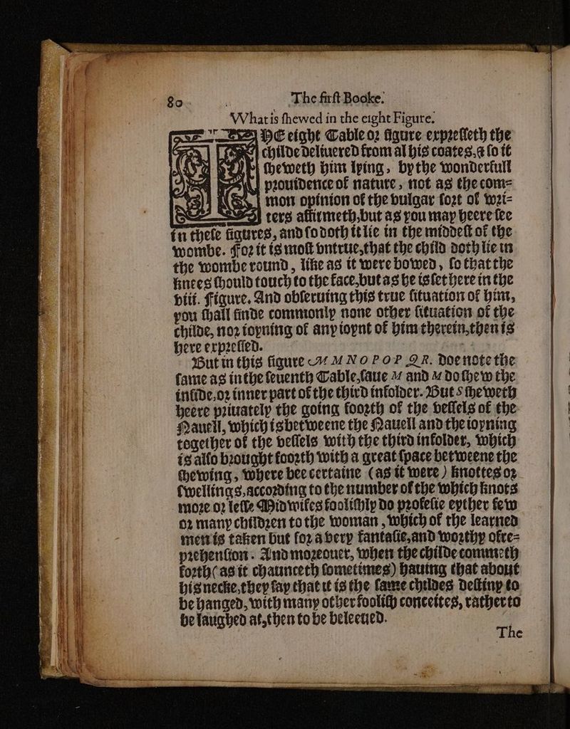 Rn rr eer Oe Eeee s wi a’ Mise eat a F — wre — - Ce eh oe eS eae oe ae ce ee Ro : The fnft Booke. Whatis fhewed in the eight Figure. pa HE eight Cable oz Figure exprelleth the e fags) childeDeliuered from al bis coates.¢ fo t€ ALY wy heweth Hin iping, bythe wonderfull Bh eM prouidenceof nature, tot as the com= a ANS, | mor opinion of the buigar fozt of wei 2S} ters affitmeth,but as you may beere fee fn thele figures, andfodorh tiie tn the middetl of the wombe. oz it (8 mo bntruc,that the child doth ite tn the womberound, tie as tt were bowed, fo thatthe Huees ould touch to the face,butas be telethere tn the Hitt. Figure. And obferving this true {ituation of hint, you thal finde commonly none other {ttuation of the childe, 102 fopnitng of any topnt of bimtheretn,toenis: here erpzetied. : fren, 2 Wut tn this figure 7 MNO POP QR. Doenote tive fate ag inthe feuenth Cable,faue 47 and 7 Do thew the = infide.oz inner part of the third tnfolder. Outs hewery = Heere pritrately the going foorth of the veflels of the i | Nauell, which isbetweene the Qauecllandthetopning | together of the bellels with the third infolder, which ig alfo brought foo2rth with a great {pace betweene the (hewing, where beccertaine (asi were ) knottes o2 Cwellirigs.accosding to the nuntber of the which knots an moze 02 lefle Win wifes footihlp Do peotetic epther few pe o2 many childzen tothe woman , which of the learned a : nies taken Dut for aberp fantatie,and wozthy ofre= an prchention. Andmozeouct, when the childe conmecth antl forth(asit chaunceth fometines) bautng that about e hii visnecke,they fap chat ct is the Cause chiles Delliny to Pia be hanced, with many other footltt concettes, ratherto a He tauched at,then tobe beteened.