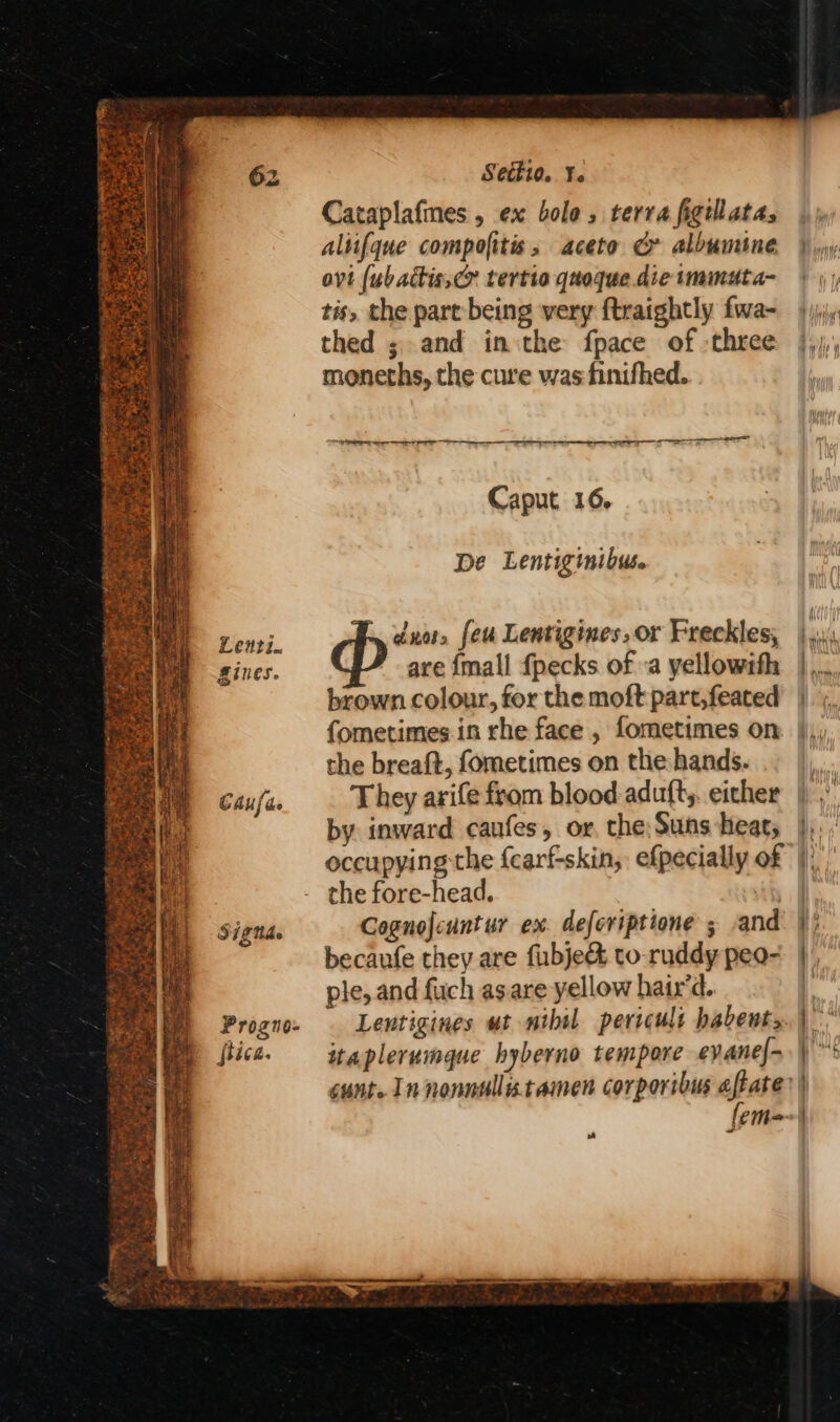 Lenzi. gines. Causa Signae Progno- {tica. Setki0. Ye Cataplafmes , ex bole, terra figilatas altifque compofitis, aceto Cr albumine ovi (ubactis,&amp; tertio quoque. die tmmuta- tis, the part being very ftraightly fwa- thed ; and inthe fpace of -three moneths, the cure was finifhed. one aoe See Caput 16. De Lentigmibus ~, not, (eu Lentigines, or Freckles, are {mall {pecks of -a yellowifh brown colour, for the moft part,feated fometimes in rhe face , fometimes on the breaft, fometimes on the hands. They arife from blood aduft,. eicher by inward caufes, or. the: Suns heat, occupying the {carf-skin, efpecially of the fore-head. : Cognofcuntur ex. defcriptione ; -and becaufe they are fubje&amp; to-ruddy peo- ple, and fuch asare yellow hair'd. itaplerumque hyberno tempore evane{- cunt. In nonnulltamen corporibus aftate cd : # i) Hy