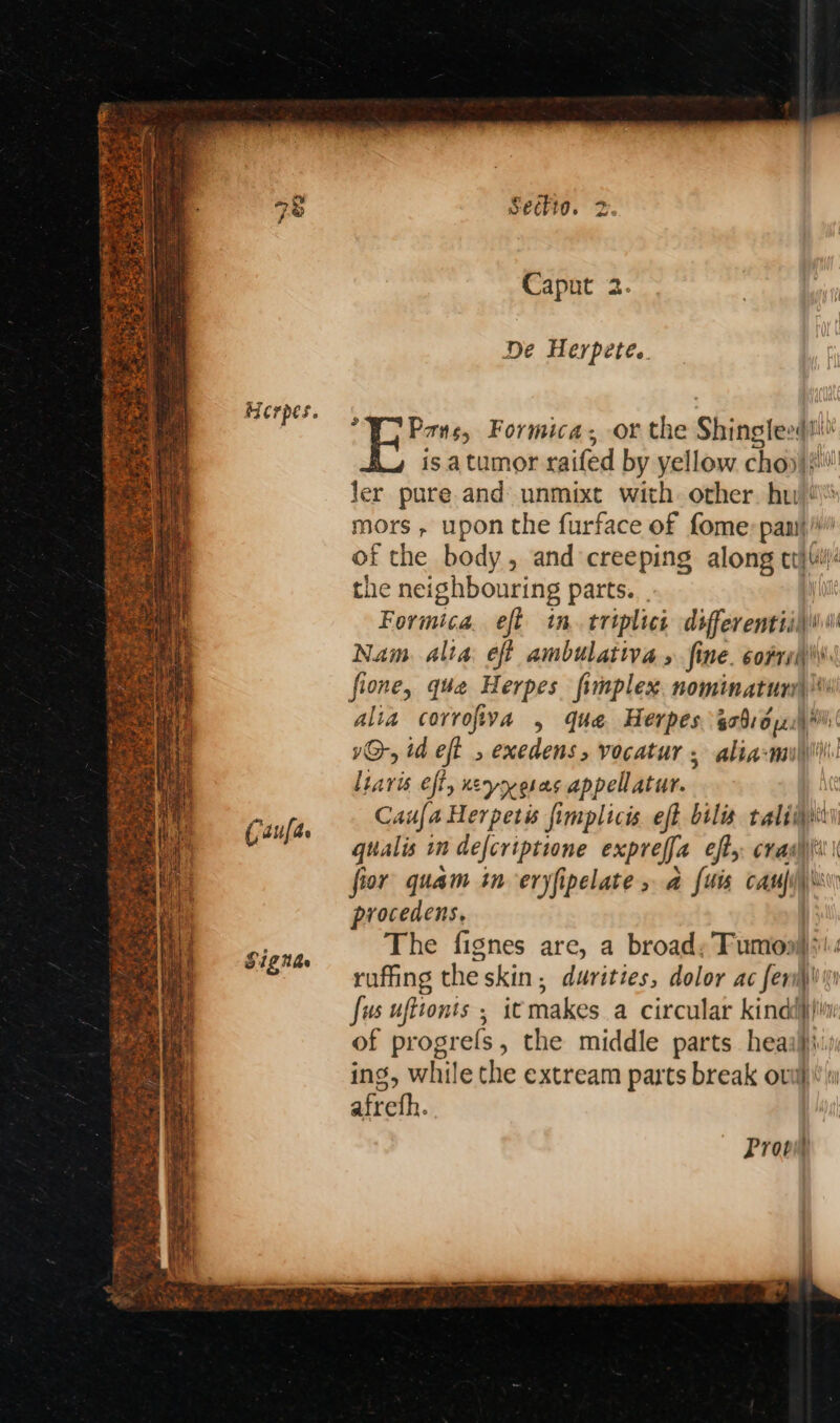 Caput 2 De Herpete.. Pas, Formica; or the spe pre i is atumor raifed by yellow choy} Jer pure.and unmixt with. other. hw! mors , upon the furface of fome: pani}! of the body, and creeping along citi the neighbouring parts. . Formica. eft in. triplict differentiil Nam. alta eff ambulativa » fine. cof fione, quae Herpes fimplex. nominaturs| alia corrofiva , que Herpes tae | i“ 1G, id eft , exedens, vocatur ; alia-mi liaris eft, neyreras appellatur. Caufa Herperis fimplicis. eff bilis taliiiy qualis in defcriptione expreffa eft: cra) fior quam in eryfipelate , a {uis sais hi procedens, The fignes are, a broady Fumonil}\: ruffing theskin, durities, dolor ac fermi fas ufttonts ; itmakes a circular kind} of progrefs, the middle parts heaali. ing, while the extream parts break oui} « afreth. Caufas Signe Prov