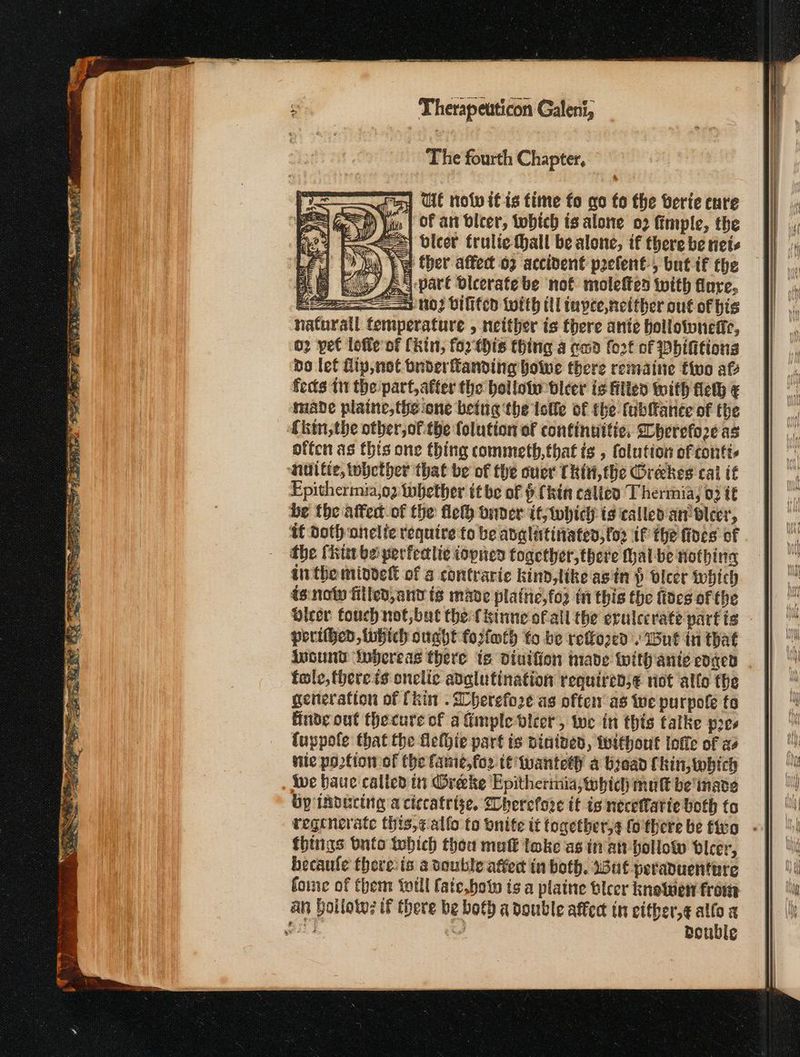 The fourth Chapter, η Ut no itis time fo go fo the berie cure A) Yaw | OF att ίσες, tobich is alone ο) fimple, the pea) bleer frulie Hall be alone, if there be tiets dud Ἐτι ther affect 02 accident prefent-, but if the KG As pare oleerate be not molefted With flare, aad NO) bilifed {with tll tuvee, neither out of bis all temperature , neither is there ante hollownefic, 02 pet loffe of Chin, for this thing a ema fot of Whifitions do [οί Lip, not bnderanding bowwe there remaine tivo af fects tn the part,atter the hollotw-bleer is illen With Πες { made plaine,the one being the tolle of the fubffanee of the offen as this one thing commeth,that is , folution of conti. nilitie, whether that be of the over Tkiti,the Φιάλες cal if Epitherimia,o2 tobether itbe of {kin calicd Thermia, 02 it be the afte of the fle onder it, which is called an’ vleer, if Doth onelie require to be anglatinates,for if the fines of the hut be perfeclie iopnen together, there Mal be nothing inthe mindett of 6 contvaric kinn,like asin } blcer Which is:noty filled,ant is mave plattie,fog i this the fides of the Dicer fouch not,but the f{kinne ofall the erulecrate' part ig porithed, tubich ought fosfmth fo be retfo2ed ut in that Anound ‘iubereas there is dinifion made with ante edged fale, there is onelic adalutination required;¢ riot ‘allo the generation of (kin . Dherefo2e as often as we purpole to finde out thecure of a Gimple vicer, Wwe in this talke pres fuppofe that the fefhie part is ninived, feithout loffe of aa vile po2tion of the fame,for tt wanteth a biead Chin, tobich iwe baue calicd ti Oreeke Epitherinia, which mutt be inate Gp inducing a ciccatrise, Cherefore it is necefatie both ία regenerate this,calfo to onite it together,g fo there be fro - things bnto tebich thea molt toke as in at hollow bleer, becaufe thereiis a vouble afer in both. Int peraduentare foine of them toll fate,bow is a plaine bleer kneluen from an boilow? tf there be both a double affect in cither,¢ allo a