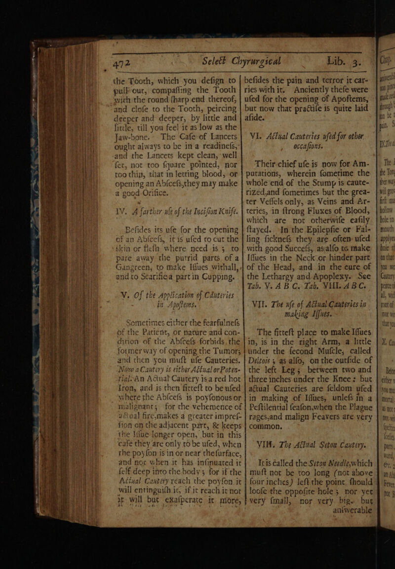 the Tooth, which you defign to | befides the pain and terror it car- ; pull our, compaffing the Tooth ries with it. Anciently thefe were | 0) with the round fharp end thereof, | ufed for the opening of Apoftems, pier and clofe to the Tooth, peircing | but now that pradtife is quite laid | fo! deeper and deeper, by little and | afide. fon Oe” fittle, till you feel it as low as the Jaw-bone. The Cafe of Lancets } VI. Actual Cauteries ufed for other ought always to be in a readinefs,- occafions. and the Lancets kept clean, ‘well ebb i fet, not too {quare pointed, nor Their-chief ufe is now for Am- roo thin, that in letting blood, or | putations, wherein fometime the opening an Abfcefs,they may make | whole end of the Stump is caute- a good Orifice. rized,and fometimes but the grea- ter Veffels only, as Veins and.Ar- LV. A farther ule of the Incifion Knife. | teries, in ftrong Fluxes of Blood, which are not otherwife eafily Befides its ufe for the opening | ftayed.. In the Epilepfie or’ Fal- of an Abjfcefs, it is ufed ro cut the | ling. ficknefs they are often: ufed skin or ficth where need is 5 to | with good Succefs, asalfo t6 make pare away the putrid parts. of a} Iffues in che Neck-or hinder part Gangreen, to make [ues withall,.| of the Head, and in the cure of and to Scarifiea part in Cupping. | the Lethargy and Apoplexy. See Tab. YA BC. Tab, VUL ABC. “o. ~ alex V. Of the Application of Cduteries in Apoftems. VII. The ufe of Atiual Cauteries in making Ines. Sometimes either the fearfulnefs sf the Patient, or nature and con- The fitteft place to make Iffues dition: of the Abfcels forbids, the | in, is in the right Arm, a little former way of opening the Tumor; } under the fecond Mufcle, called and then you muft ufe Cauteries. | Deltois ; as alfo, onthe outfhde of Now aCautery is either Adtual or Poten- | the left Legs between two and | py flaleAn Actual Cautery 1sa red hot | three inches under the Knee: but. | citer fron, ard is then ficteft to be ufed | aétual Cauteries are feldom ufed | jn my where the Abfcefs is poyfonousor | in making of Iffues, unlefS in a | moj: malignant; for the vehemence of | Peftilential feafon,when the Plague | gp, aGval firesmakes a greater impref- rages,and malign Feavers are very Sar. oR ey ao tae Oe A reg a s - Bae ue wp er eer orem tenement fion on the adjacent part, &amp; keeps | common. the line longer open, but in this cafe they are only to be ufed, when | rhe poyfon is in or near thefurface, and nor when it has infinuated ir (elf deep into the body 5 for if the Atiual Cantery reach the poyfon it VIM. The Actual Setow Cautiry. a ee = Itis called the Seton Needle,which | muft not be too long (not above ! é four inches) Jefe the point. fhould | will entinguilh it, if it reach itnor | loofe the oppofite hole ; nor yer | a will but exafperate ic more, } very fmall, nor very. big. bug DO ayes ae fa Buy ae antwerable a _— a SS Fe SS OS i = _ = ~ at soe ~ EN fm! See 1 Ri eT Jas = =