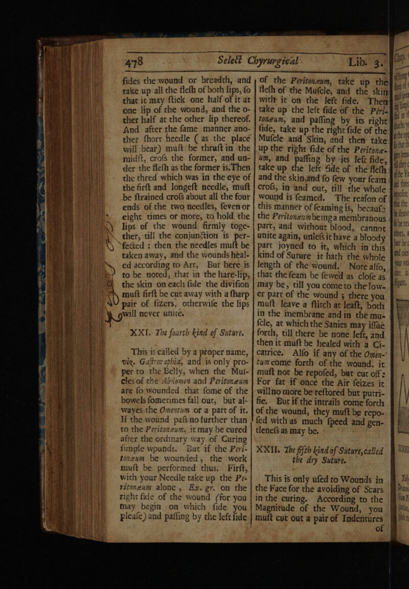 ) - 478 Lib. 3. fides the wound or breadth, and take up all che flefh of both lips, fo that ic may ftick one half of it at one lip of the wound, and the o- ther half at the other lip thereof. And after the fame manner ano- ther fhort.tieedle ( as the. place will bear) muft be thruft in the midft, crofs the former, and un- der the flefh as the former is. Then the thred which was in the eye of the firft and longeft needle, muft be ftrained crofs about all the four ends of the two needles, feven or eight times or more, to hold the lips of the wound firmly toge- ther, till the conjun&amp;tion is per- “feGted ; then the néedles muft be ed according to Art, But here. is to be noted, that in the hare-lip, the skin on each fide the divifion pair of fizers, otherwife the lips will never unite. XXL. The fourth kind of Suture. This 3s called by a proper name, viz. Galtroraphia, and is only pro- per to the Belly, when the Mut- cles of the Abdomen and Peritoneum are fo wounded . that fome of the bowels fometimes fall out, but al- wayes the Omentum or a part of it. If the wound pafino further than to the Peritoz.eum, it may be cured after the ordinary way. of Curing fimple wounds. But if the Pevi- tozeum be wounded, the work muft be performed’ thus. Firit, with your Needle rake up the Pe- ritoneum alone, Ex. gr. on the right fide of the wound (for you may begin on which fide you of the Peritoneum, take up the Heth of the Mufcle, and the skin witlt it on the left fide. Then take up the left fide of the PéHi- toneum, and pafling by its right um, and paffing by its lef fide, take up the left “de of the fleth and the skin.and fo few your feam wound is feamed. The reafon of this manner of feaming is, becaufs the Peritoneumbeinga membranous part, and without blood, cannot unite again, unlefsit have a bloody part joyned to it, which in this kind of Suture it hath the whole length of the wound. Note alfo, that the feam be fewed as’ clofe as may be, till you come to the low- er part of the wound 5 there you muft. leave a ftitch at leaft, both in the membrane and in the mue (cle, at which the Sanies may iffue forth, till there be none left, and then it muft be healed with a Ci- catrice. Alfo if any of the Omen-' tam come forth of the wound, it muft not be repofed, but cut off : For fat if once the Air feizes it willno more be reftored but fie. But if the intrails come forth of the wound, they muft be repo- fed with as much {peed and gen- tlenef§ as may be. XXII. The fifth kind of Sature,called the dry Suture. This is only ufed to Wounds in the Face for the avoiding of Scars inthe curing. According to the Magnitude of the Wound, you mufi cut ont a pair of mare Pe | ° — —- of ony fn lt i bp! pin thats itthe off fo tut th sored tl they dithe F: aid thre ippotte that the Me draw dere cines, 2 bt be id ties Dracn Gin if Wvtin, tity), 4 fit fy