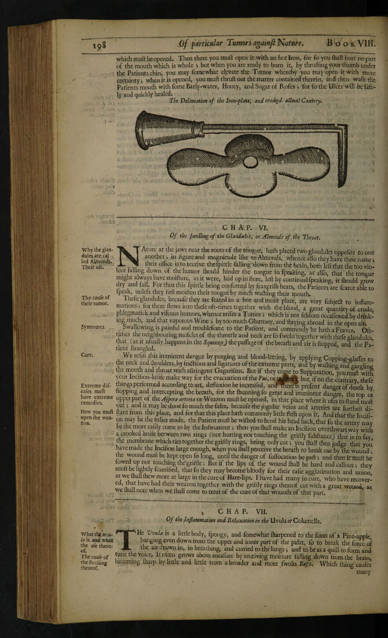 which muft be opened. Then there you mufl open it with an hot Iron, for fo you lhall hurt no part of the mouth which is whole *, but when you are ready to burn it, by thruftingyour thumb under the Patients chin, you may fonacwhat elevate the Tumor whereljy you may open it with more certainty j when it is opened, you muft thruft out the matter contained therein, and then wafti the Patients mouth with fome Barly-water, Honey, and Sugar of Rofes j for fo the lillcer will be fafe- ly and quickly healed* The Delineation vf the Iron-Opiate^ and crooked aUml Cautery, .1 -0 Why the glan¬ dules are cal * • led Atoonds* Their ufe. The caufe of their tumor. Symtomes, Cure, f Extreme dif- cafes muft have extreme remedies. How you muft open the wea- zon. , ' C H A P. VI. ■ Of the Jirdliiig <f the Glimihks. 'm'Almonds of the TImat. n. . - • ^ Ature at the Jaws near the roots of the tbngue, hath placed two glandules oppofite toonc •I another^ in figure and magnitude like to Almonds, whence alfo they have their name i X ^ t^ir office is to receive the fpittle falling' 'down from the brain, both left that the too vio¬ lent falling down of the humor ffiould hinder the tongue infpeaking, as'alfo, that thetoneuc might always have moifture, as it were, laid upinftore, left by continual fpeaking, it ffiould grow dry and fail, f or thus this fpittle being confumed by feavpriffi heats, the Patients are fcarce able to ipeak, unleis they hrft moiften their tongue by much waffiing their mouth. Thefe glandules, becauffi they are feated in a hot and moift place, are very fubjedf to inflam- niations-,_for there flows into thefeoft-times together with theblood, a great quantity of crude, phlegmatick and vikous humors, whence arifes a Tumor ^ which is not feldom occafioned by drink¬ ing much, and that vaporous Wine i bytoo much Gluttony, and flaying abroad in the open air. ^ Swallowing is painful and troublefome to the Patient, and commonly he hath a Feaver. Gft- times the neighbouring mufcles of the throttle and neck are fo fwoln together with thefe glandules, that (as it ulually happens in the Squinzy) the paftage of the breath and air is ftopped, and the Pa¬ tient ftranglcd. We refill this imminent danger by purging and blood-letting, by applying Cupping-glafTes to the neck and ffiouldcrs, by friaions and ligatures of the extreme parts, and by waffiing and gargling the mouth and throat with aftringent Gagarifms. But if they come to Suppuration, you muft with your Incilion-knife make way for the evacuation of the Puf, or but, if Ori the contrary. thefe things performed according to art, defluxion be increafed, and^Kr?is prefent danger of death by flopping and intercepting the breath, for the ffiunningfo great and imminent danger, the top or upper part of the JJpera arteria or Weazon muft be opened, in'that place where it ufes to ftand moft out, and it may be done fo much the fafer, becaufe the jugular veins and arteries are furtheft di- ftant from this place, and for that this place hath commonly little fteffi upon it. And that the Incili- on may be the htlier made, the Patient muft be wiffied to bend his head back, that fo the artery may be the more eafily come to by the Inftrument i then you ffiall make an Incifion overthwart way with a crooked kpife between two rings (not hurting nor touching the griftly fubftancej that is-to fay the membrahe which ties together the griftly rings, being only cut j you ffiall then judge that you have made the Incifion large enough, when you ffiall perceive the breath to break out by the wound the wound muft be kept open fo long, until the danger of fulfocation be paft i and then ifmuft be fowedupiTot touching the'griftle: But if the lips of the wound ffiall be hard and callous-, they muft be lightly fearrffied, that fo they may become bloody for their eafie agglutination and union as we ffiall Ihew more at large in the cure of Hare-lips. I have had many in cure, who have recover- ed, that have had their weazon together with the griftly rings thereof cut with a great wound as we ffiall note when we lhall come to treat of the cure of that wounds of that part. * ^ CHAP. VII. Of the Infiammation and Relaxation in the Uvula or Columella. la is, and what the ufe there¬ of. The caule of the fvveiling thercaf. He Vvula is a little body, fpongy, and fbmewhat ffiarpened to the form of a Pine-apple hanging even down from the upper and inner part of the palat, fo to break the force of the air drawn in, in breathing, and carried to the lungs i and to be as a quill to form and tune the voice. It often grows above meafure by receiving moifture fallipg down from the brain, hecQining Iharp by little and little from a broader and more fwolii Bafs. Which thing caufes many