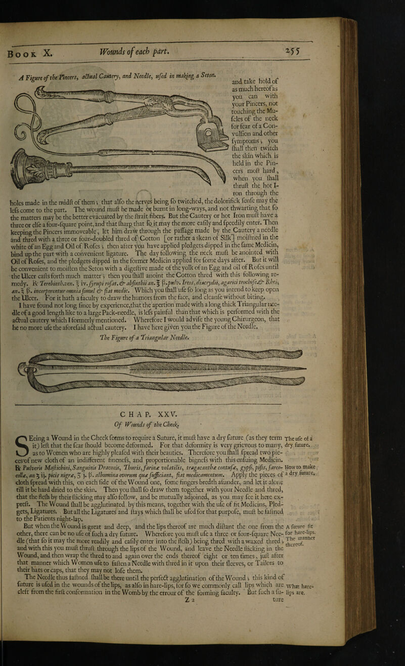 A Figure of the Fmcers^ a&ual Cautery^ and Needle, ufed in ml^ng a Seton. and take Hold of as much hereof as you can with your Pincers, not touching the Mu- fcles of the neck for fear of a Con- vulfion and other fymptoms ■, you (hall then twitch the skin which is held in the Pin¬ cers moft hard, when you fliall thruft the hot I- ron through the holes made in the midft of them •> that alfo the nerves being fo twitched, the dolorifick fenfe may the lefs come to the part. The wound muft be made or burnt in long-ways, and not thwarting that fo the matters may be the better evacuated by the ftrait fibers. But the Cautery or hot Iron muft have a three or elfe a four-fquare point, and that (harp that fo it may the more eafily and fpeedily enter. Then keeping the Pincers immoveable, let him draw through the paffage made by the Cautery a needle and thred with a three or four-doubled thred of Cotton [or rather a skean of Silk] moiftned in the white of an Egg and Oil of Rofes •, then after you have applied pledgets dipped in the fame Medicin, bind up the part with a convenient ligature. The day following the neck muft be anointed^ with Oil of Rofes, and the pledgets dipped in the former Medicin applied for fome days after. But it will be convenient to moilten the Seton with a digeftive made ot the yolk of an Egg and oil of Pv.ofes until the Ulcer cafts forth much matter i then you lhall anoint the Cotton thred with this following re¬ medy. R ‘lerebinth.ven* | iv.Jjrupi rofat, abfmtbii an. ^ ^.pnlv. Ireos, diacrydh, agarici trochifc.&‘ Khe}, an. % (i. incorporentur omniafimul &• fiat medic. Which you (hall ufe fo long as you intend to keep open the Ulcer. For it hath a faculty to draw the humors from the face, and cleanfe without biting. 1 have found not long fince by experience,that the apertion made with along thick Triangular nee¬ dle of a good length like to a large Pack-needle, is lefs painful than that which is performed with the a<^al cautery which I formerly mentioned. Wherefore I would ad vife the young Chirurgeon, that t he no more ufe the aforefaid a6tual cautery. I have here given you the Figure of the Needle. , T^he Figure of a triangular Needle. CHAP. XXV. Of Wounds of the Cheek* SEeing a Wound in the Cheek feems to require a Suture, it muft have a dry future (as they term The ufe of i it} left that the fear fhould become deformed. For that deformity is very grievous to many, dry future, as to Wofneh who are highly pleafed with their beauties. Therefore you ftiall fpread two pie- ' > ces-ofnew cloth of an indifferent finenefs, and proportionable bignefswith this enfuing Medicin. cloth fpread with this, on each fide of the Wound one, fome fingers bredth afunder, and let ft alone till it be hard dried to the skin. Then you (hall fo draw them together with your Needle and thred, that the flelh by their flicking may alfo follow, and be mutually adjoined, as you may fee it here ex- preft. The Wound (hall be agglutinated by this means, together with the ufe of fit Medicins, Pled¬ gets, Ligatures; But all the Ligatures and flays which (hall be ufed for that purpofe, muft be faltned to the Patients night-lap. But when the Wound is great and deep, and the lips thereof are much diftant the one from the a future fir other, there can be no ufe of fuch a dry future. Wherefore you muft ufe a three or four-fquare Nee- fo'* hare-lips, die (that fo it may the more readily and eafily enter into the flefti} being thred with a waxed thred •, and with this you muft thruft through the lips of the Wound, and leave the Needle flicking in the ^ Wound, and then wrap the thred to and again over the ends thereof eight or ten times, juft after that manner which Women ufe to fallen a Needle with thred in it upon their lleeves, or Tailors to their hats or caps, that they may not lofe them. The Needle thus fallned (hall be there until the perfect agglutination of the Wound *, this kind of future is ufed in the wounds of the lips, as alfo in hare-lips, for fo we commonly call lips which are what hare- cleft from the firft conformation in the Womb by the errour of the forming faculty. ‘ But fuch a fu- lips are. tare