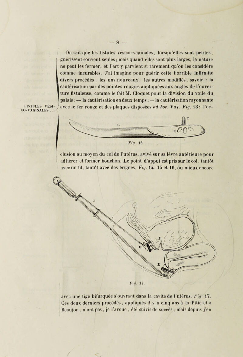 On sait que les fistules vésico-vaginales, lorsqu’elles sont petites, guérissent souvent seules; mais quand elles sont plus larges, la nature ne peut les fermer, et l’art y parvient si rarement qu'on les considère I comme incurables. J’ai imaginé pour guérir cette horrible infirmité I divers procédés , les uns nouveaux , les autres modifiés, savoir : la I cautérisation par des pointes rougies appliquées aux angles de l’ouver- lture fistuleuse, comme le faitM. Gloquetpour la division du voile du ] palais ; — la cautérisation en deux temps ; — la cautérisation rayonnante fistules vesi- j avec le fer rouge et des plaques disposées ad hoc. Voy. Fia. 13; l oc- CO-VAG1NALES_ ^ M r J \ clusion au moyen du col de l’utérus, avivé sur sa lèvre antérieure pour adhérer et former bouchon. Le point d’appui est pris sur le col, tantôt avec un fil, tantôt avec des érignes, Fig. H, 15 et 16, ou mieux encore avec une tige bifurquée s’ouvrant dans la cavité de l utérus. Fig. 17. Ces deux derniers procédés, appliqués i! y a cinq ans à la Pitié et à Beaujon , n’ont pas , je l’avoue , été suivis de succès ; mais depuis j’en